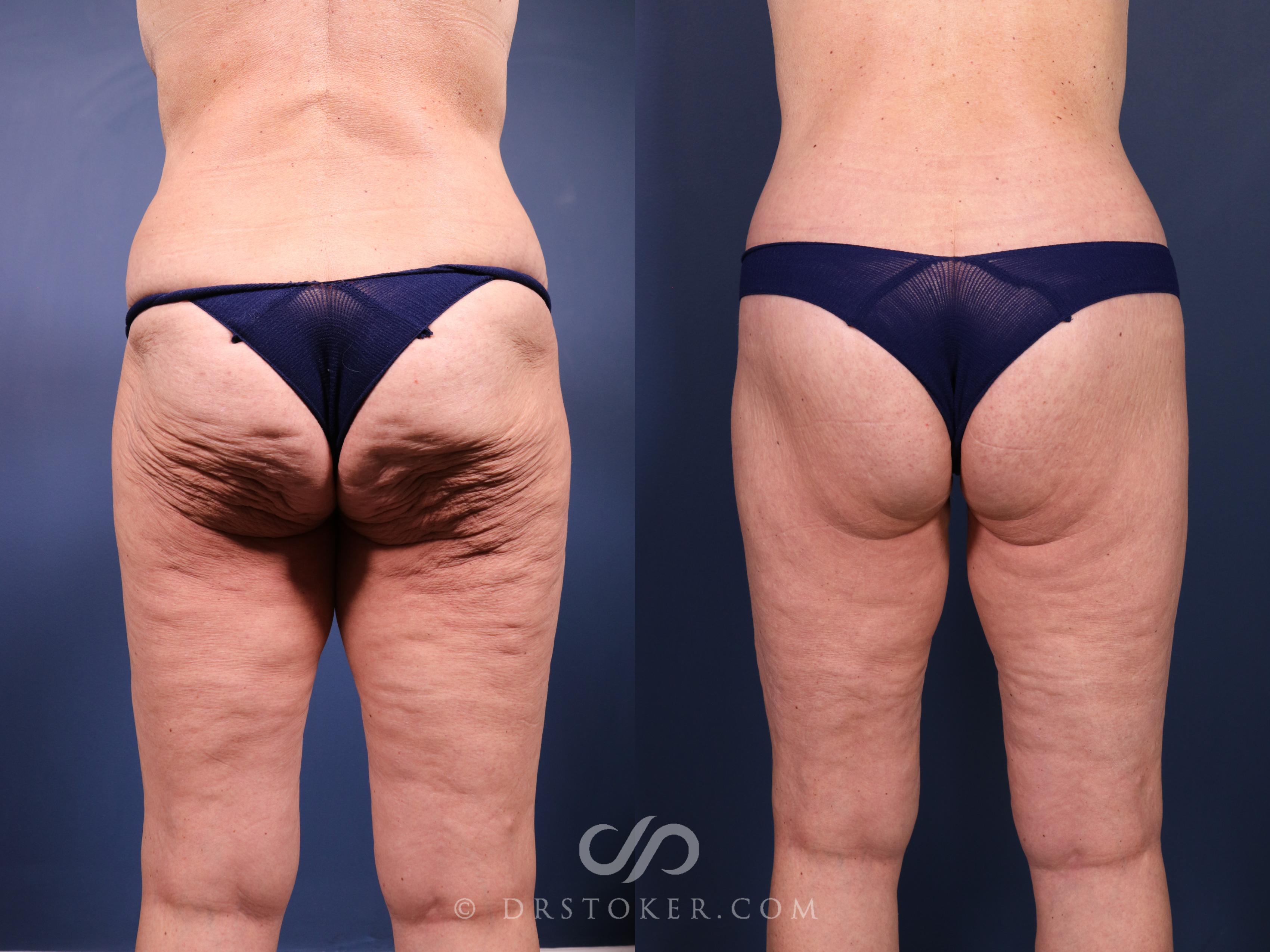 Before & After Bikini Body Lift ™ Case 2442 Back View in Los Angeles, CA
