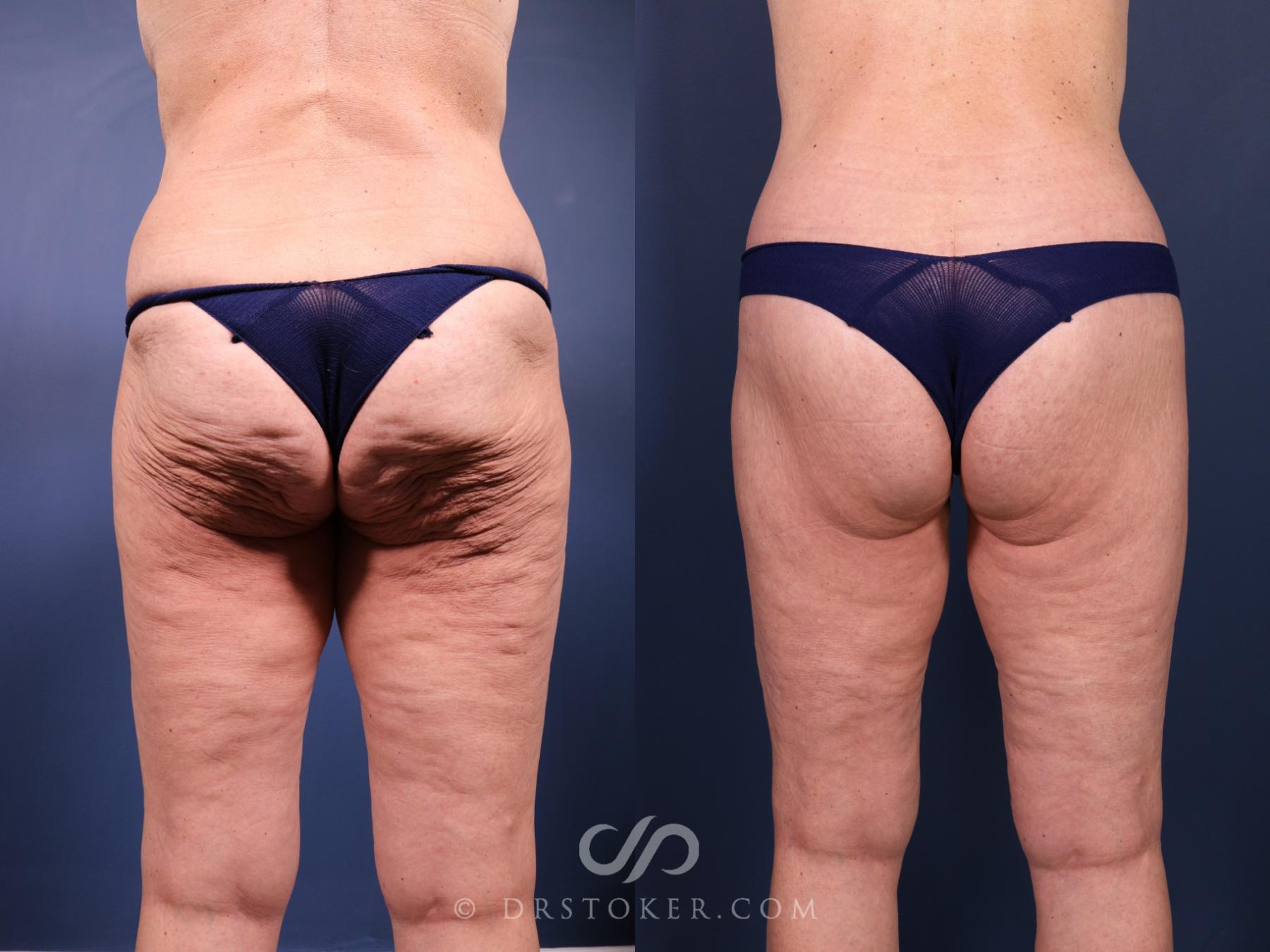 Before & After Bikini Body Lift ™ Case 2442 Back View in Los Angeles, CA