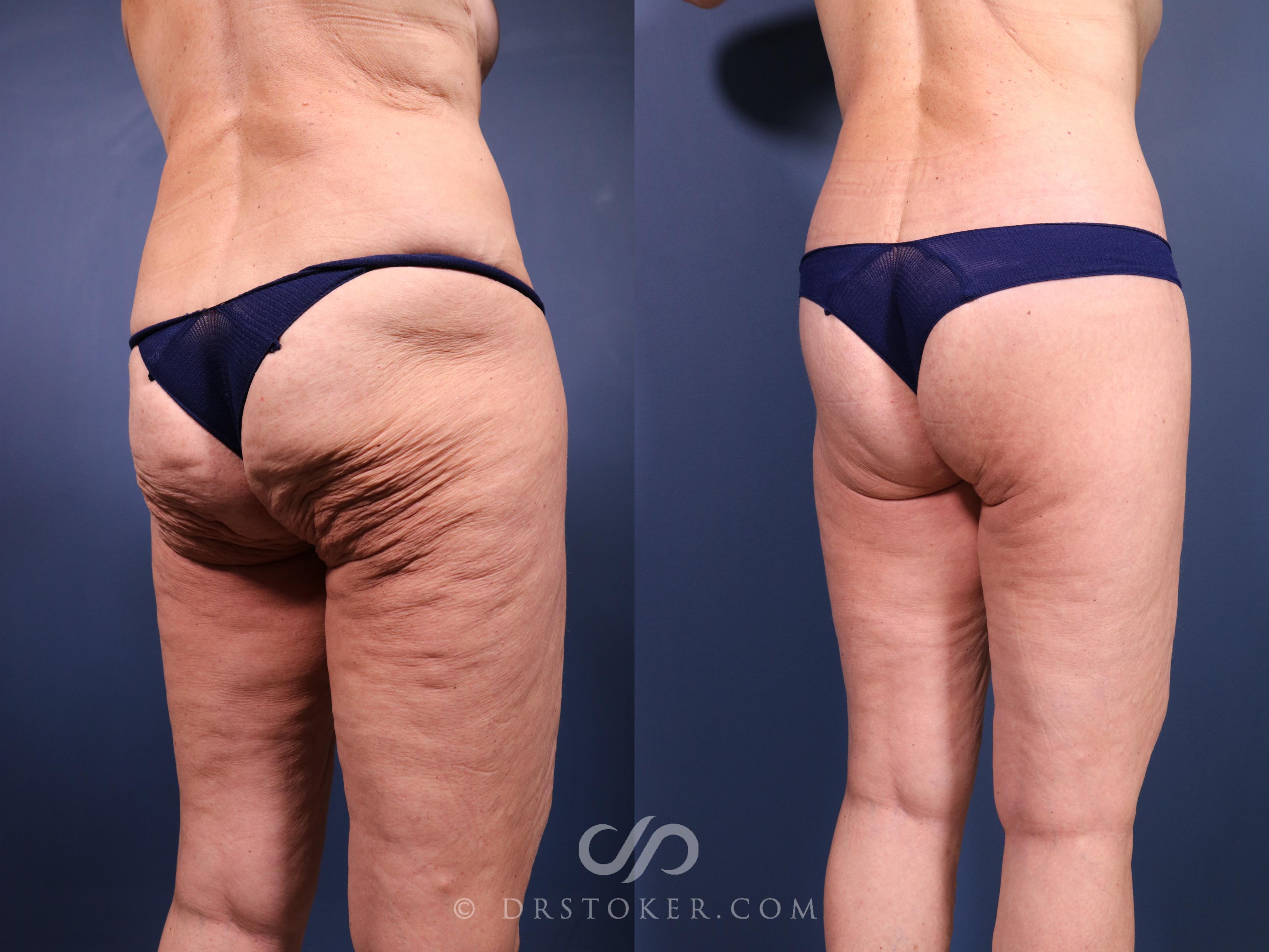 Before & After Bikini Body Lift ™ Case 2442 Right Oblique View in Los Angeles, CA