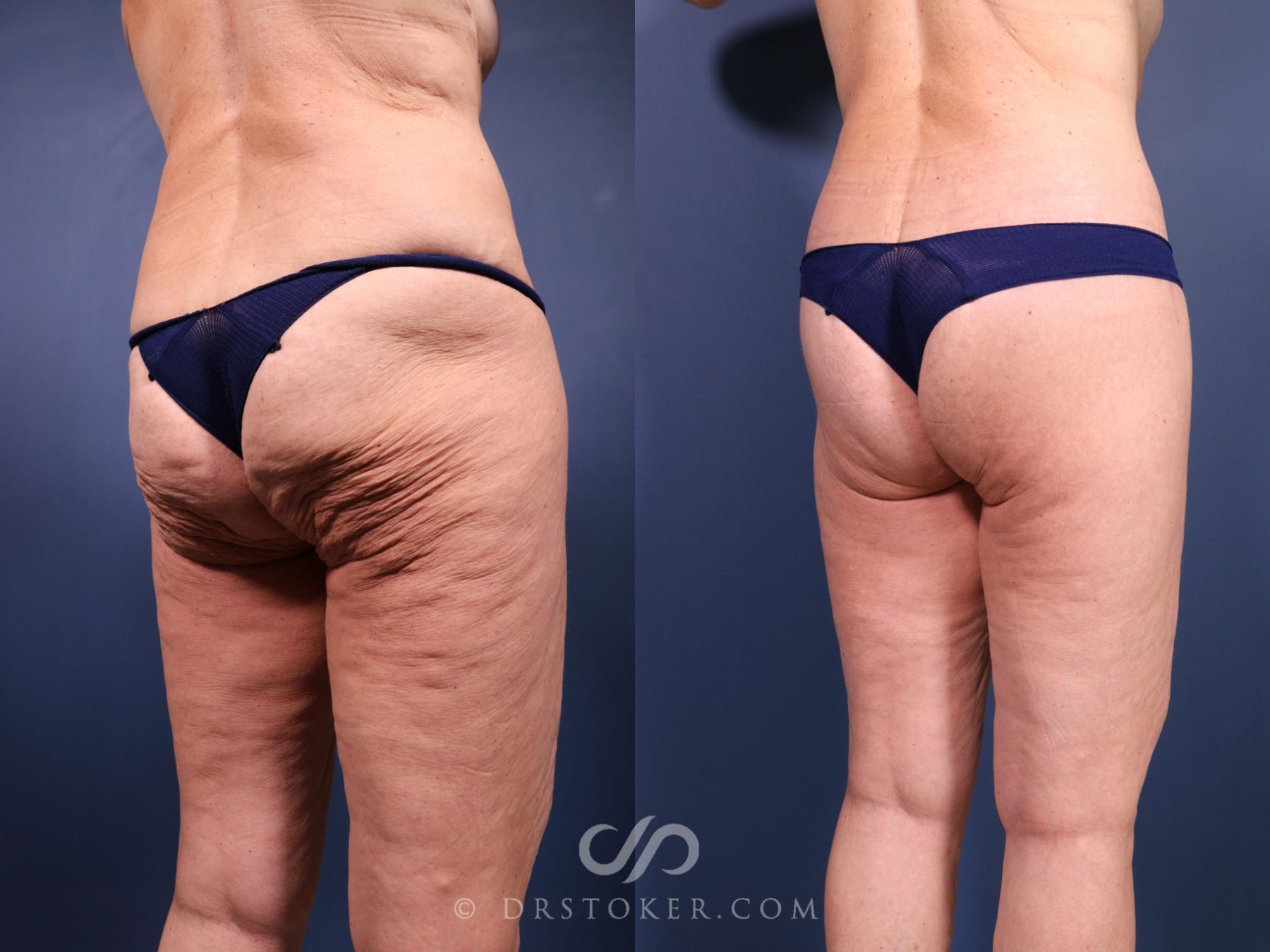 Before & After Bikini Body Lift ™ Case 2442 Right Oblique View in Los Angeles, CA