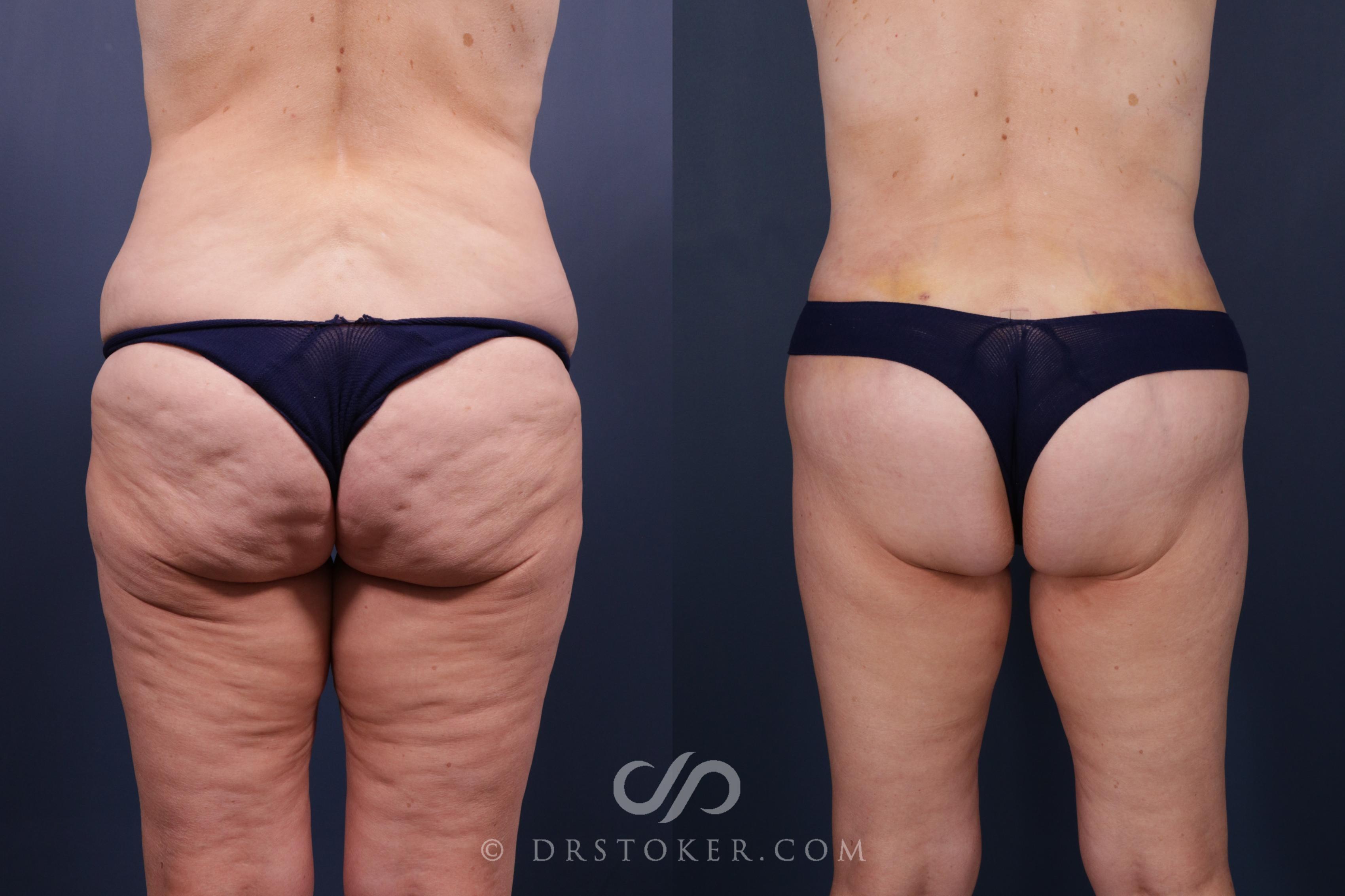 Before & After Bikini Body Lift ™ Case 2443 Back View in Los Angeles, CA