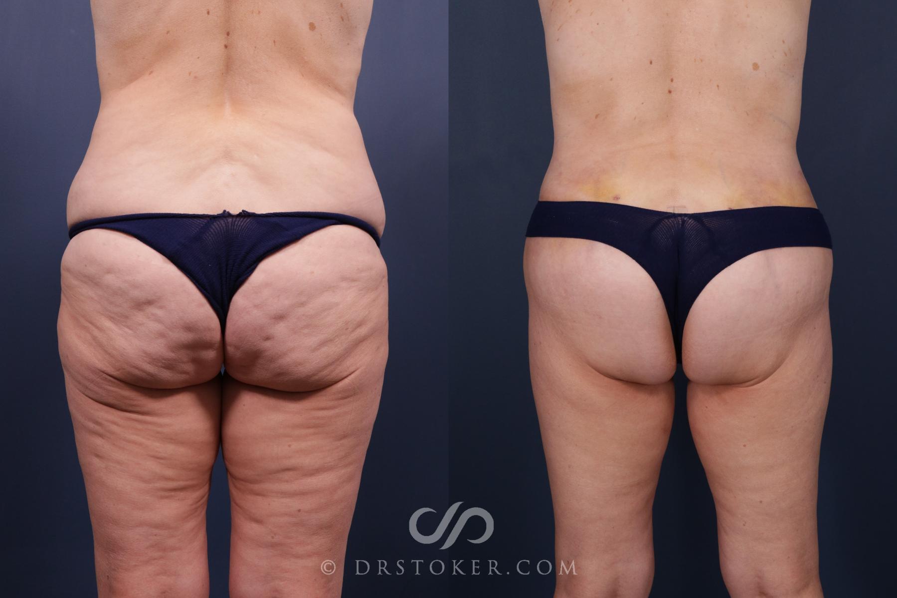 Before & After Bikini Body Lift ™ Case 2443 Back View in Los Angeles, CA