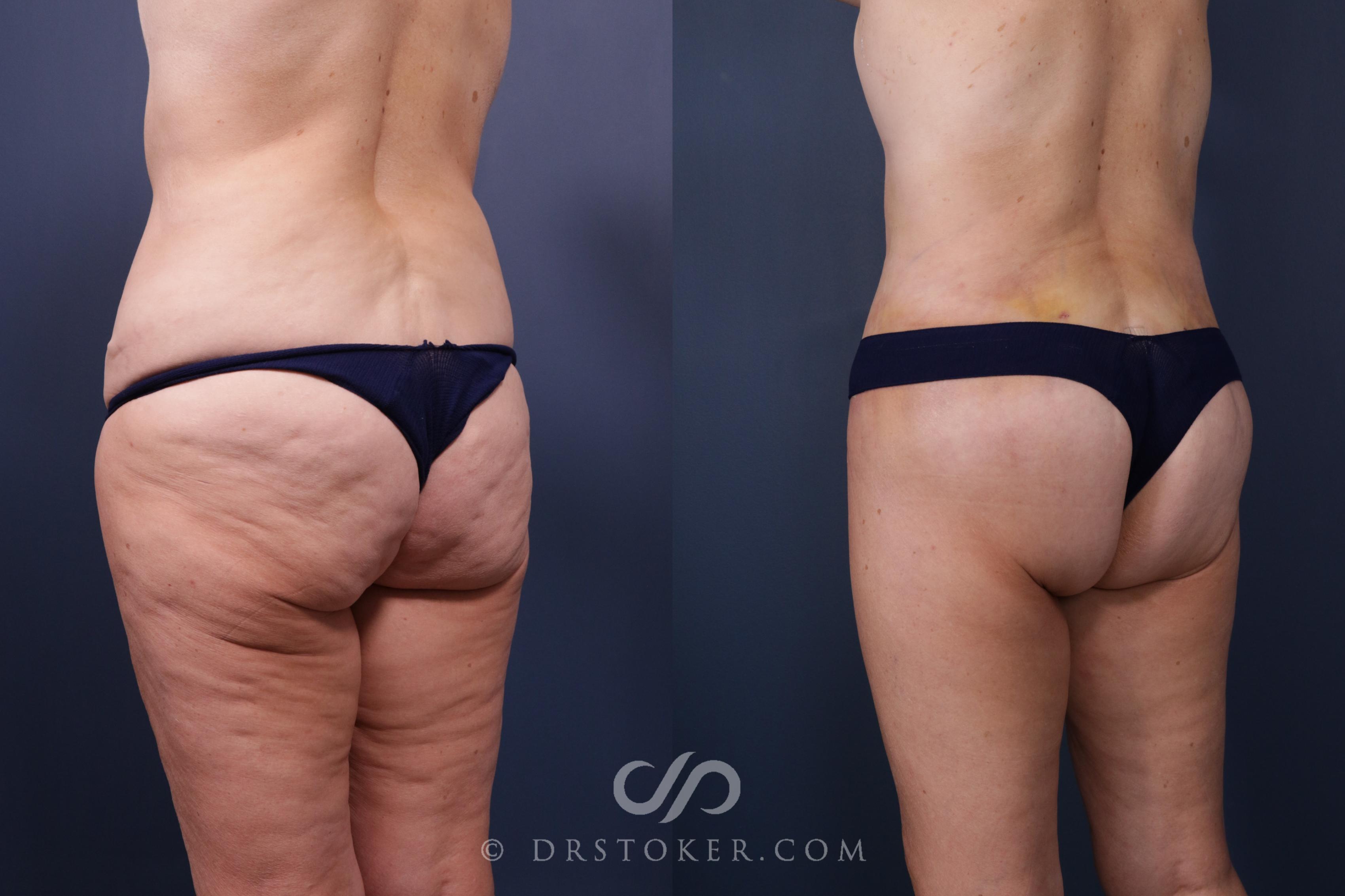 Before & After Bikini Body Lift ™ Case 2443 Left Oblique View in Los Angeles, CA