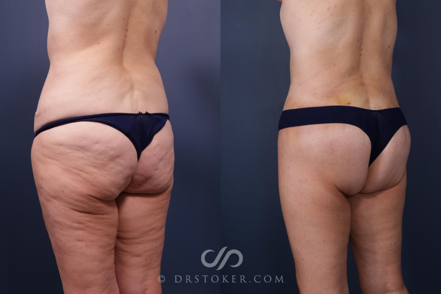 Before & After Bikini Body Lift ™ Case 2443 Left Oblique View in Los Angeles, CA