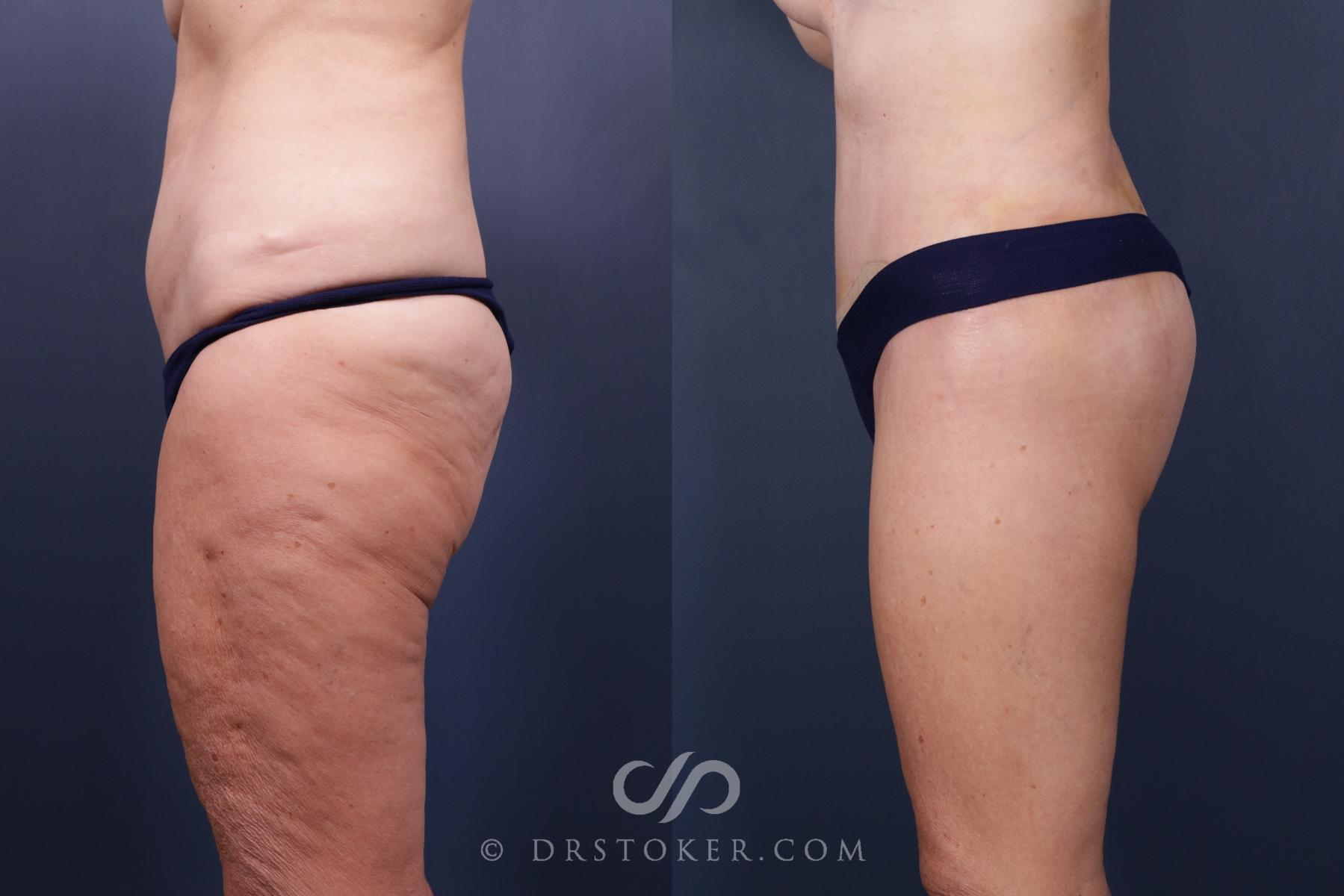 Before & After Bikini Body Lift ™ Case 2443 Left Side View in Los Angeles, CA