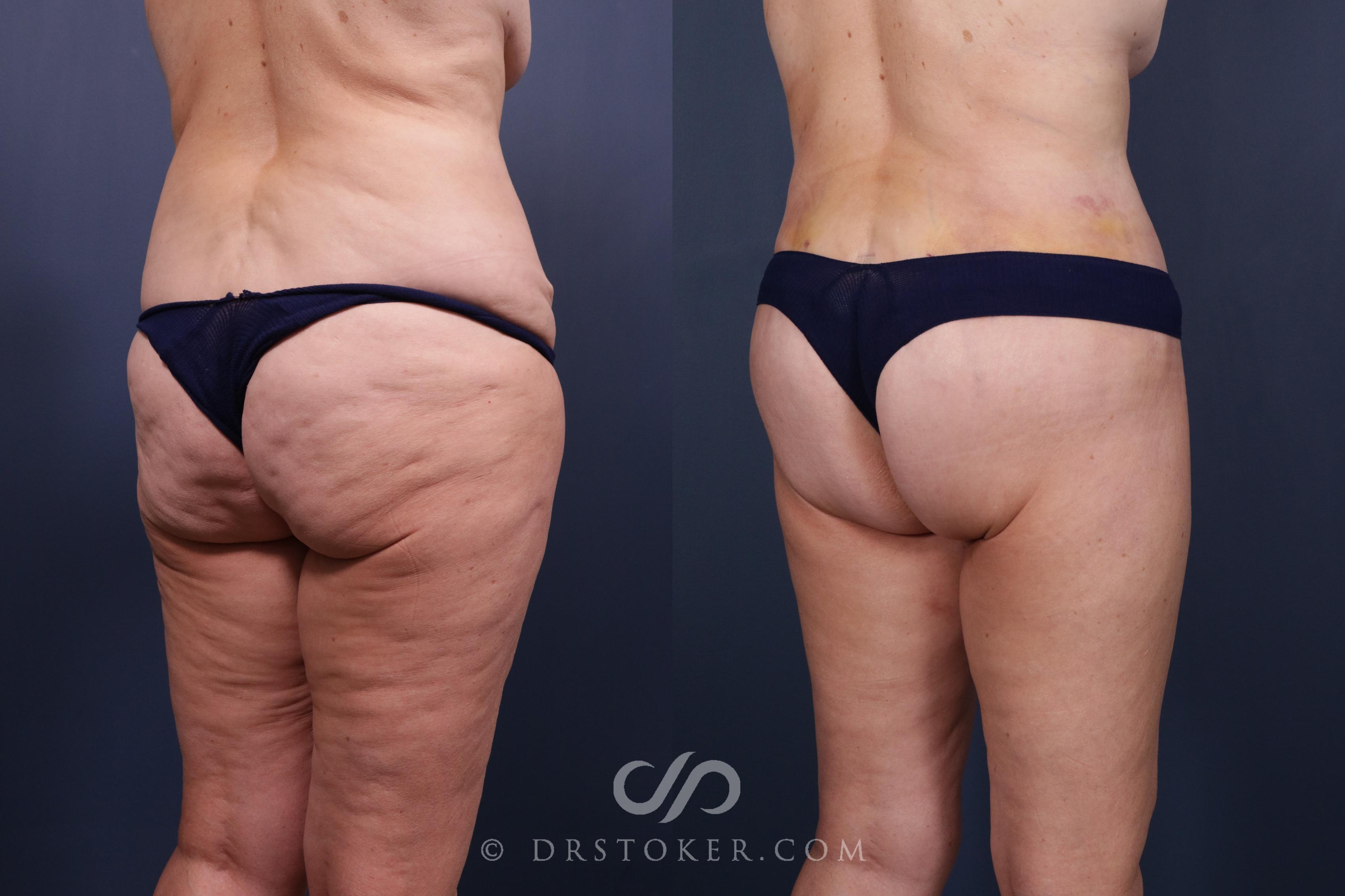 Before & After Bikini Body Lift ™ Case 2443 Right Oblique View in Los Angeles, CA