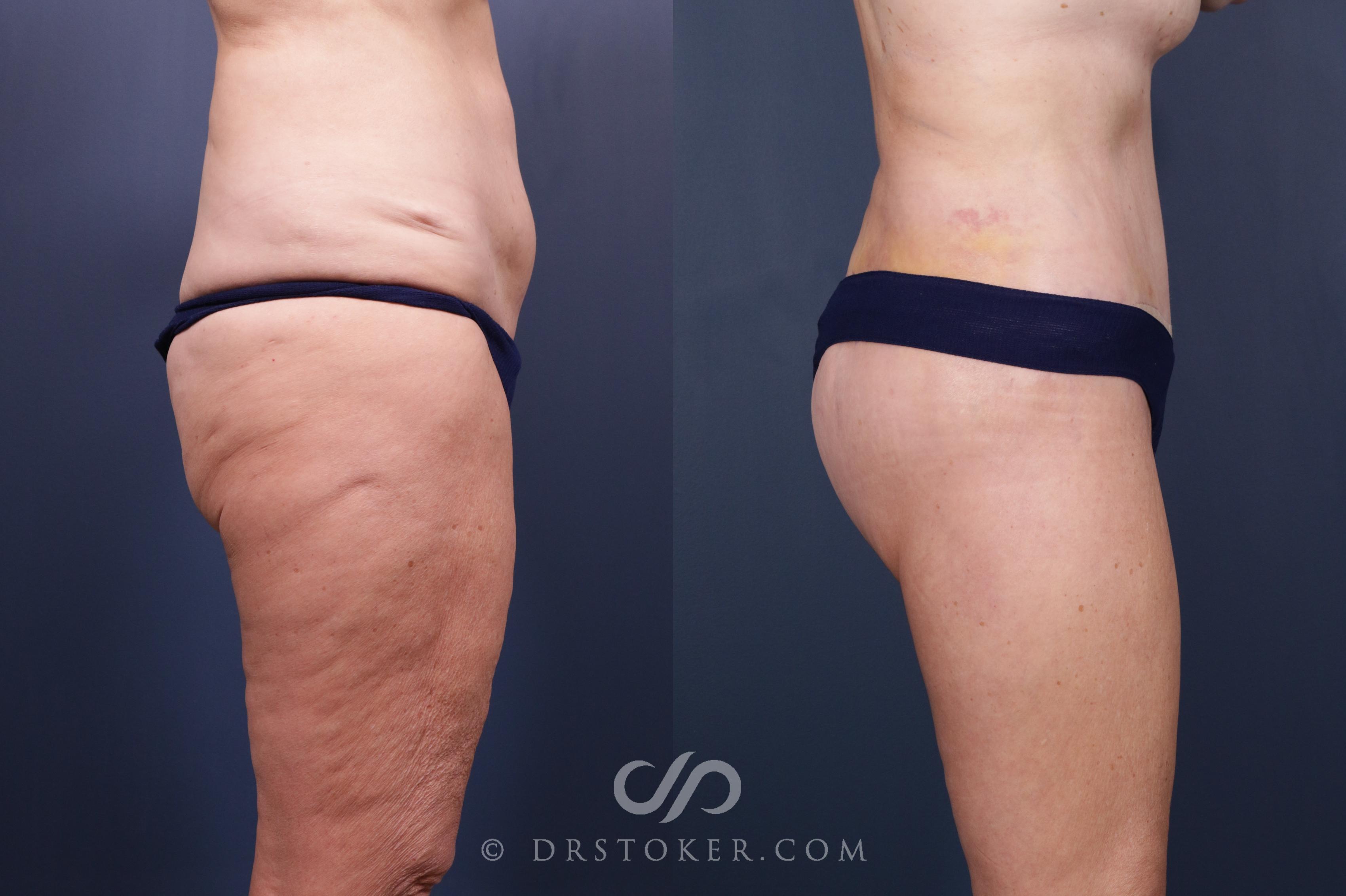 Before & After Bikini Body Lift ™ Case 2443 Right Side View in Los Angeles, CA