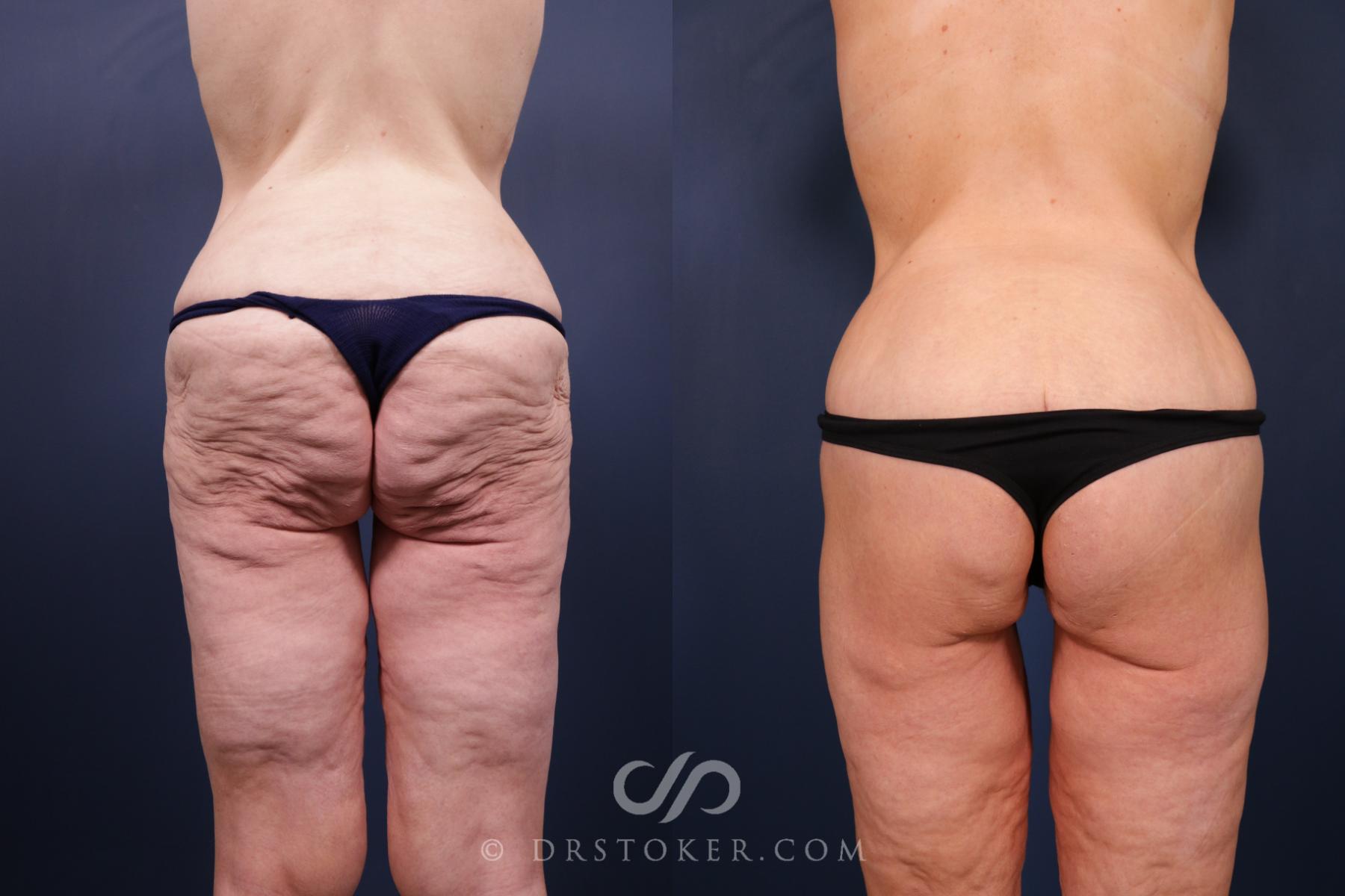 Before & After Bikini Body Lift ™ Case 2444 Back View in Los Angeles, CA