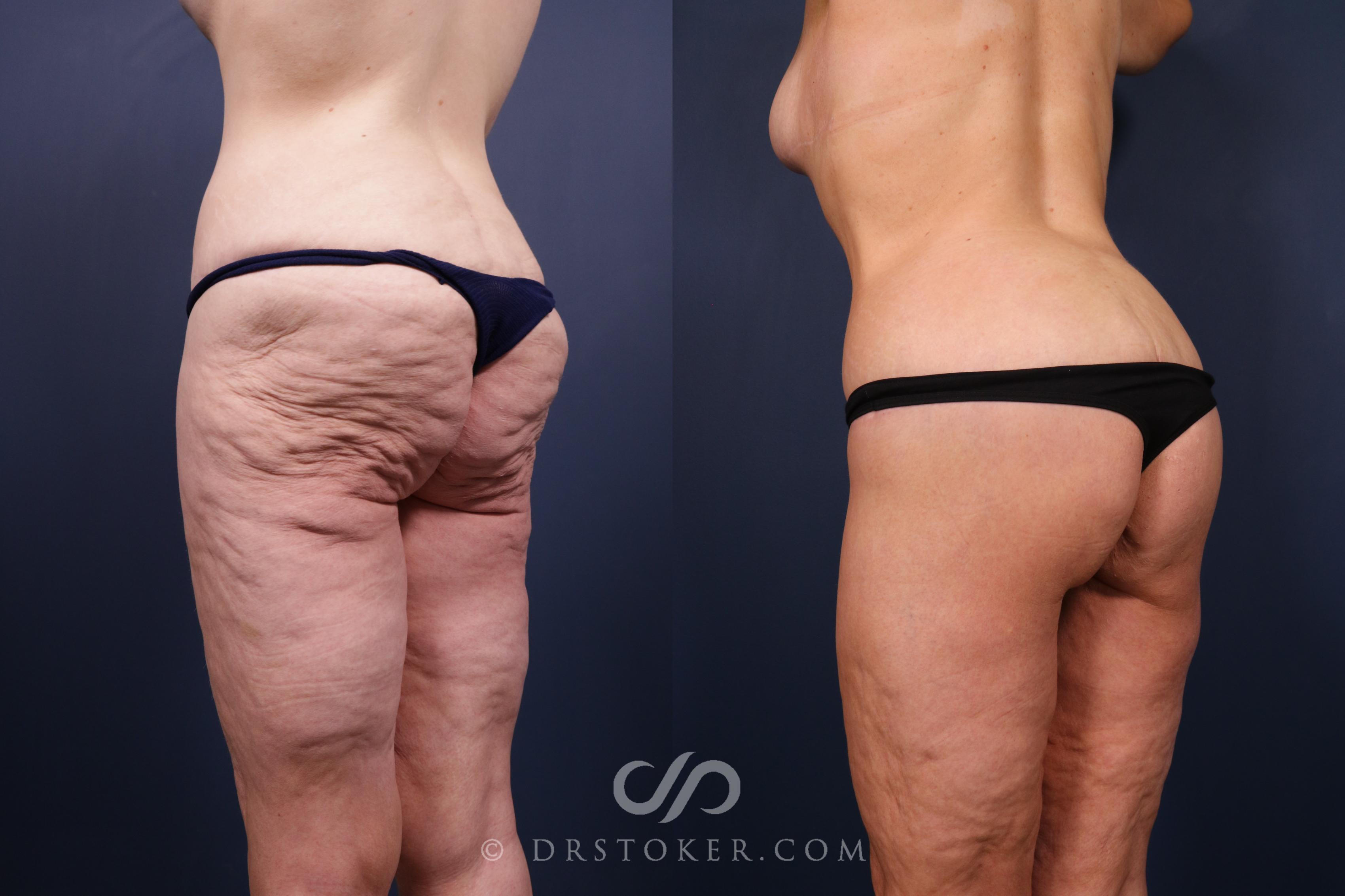 Before & After Bikini Body Lift ™ Case 2444 Left Oblique View in Los Angeles, CA