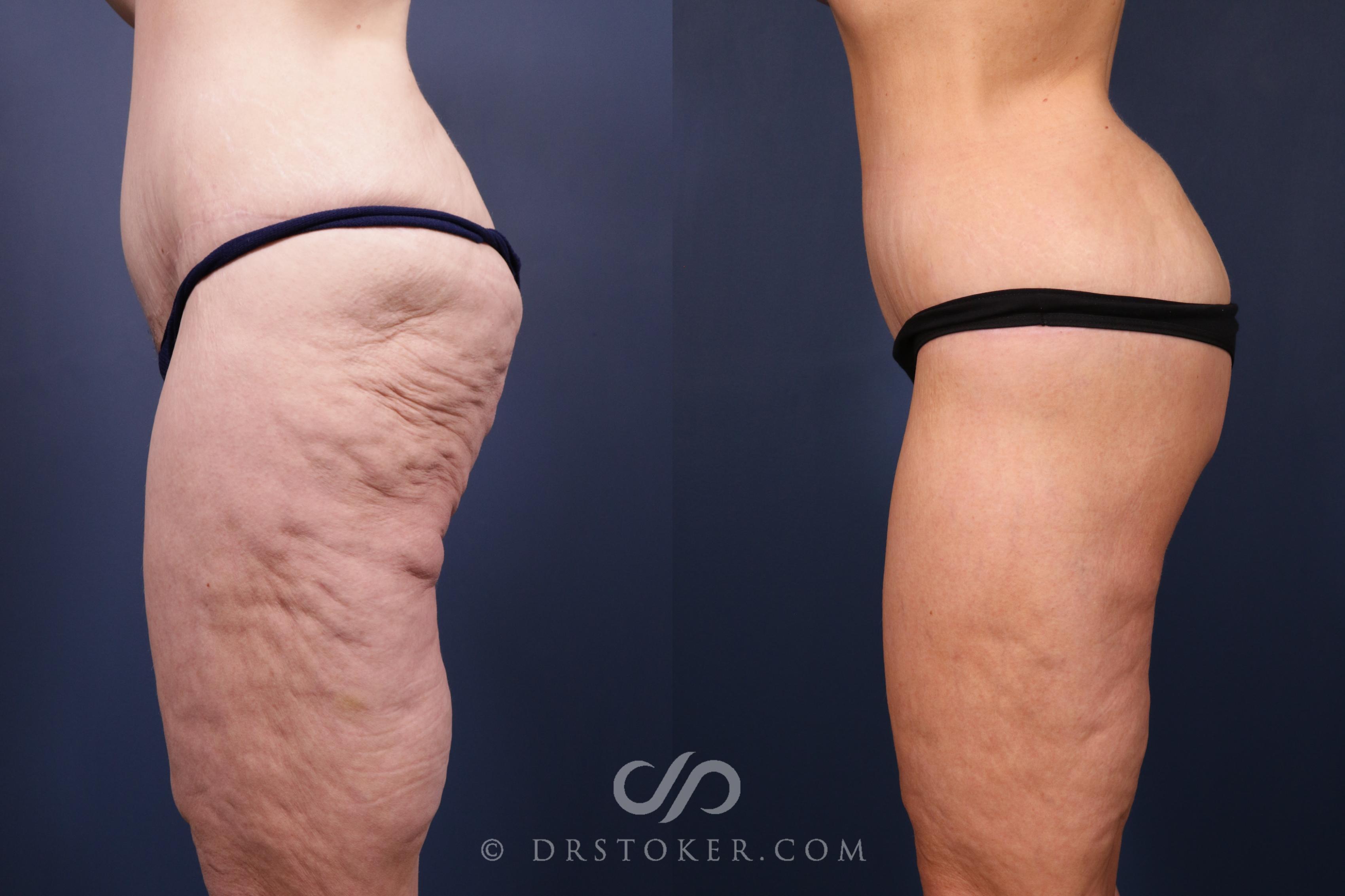 Before & After Bikini Body Lift ™ Case 2444 Left Side View in Los Angeles, CA