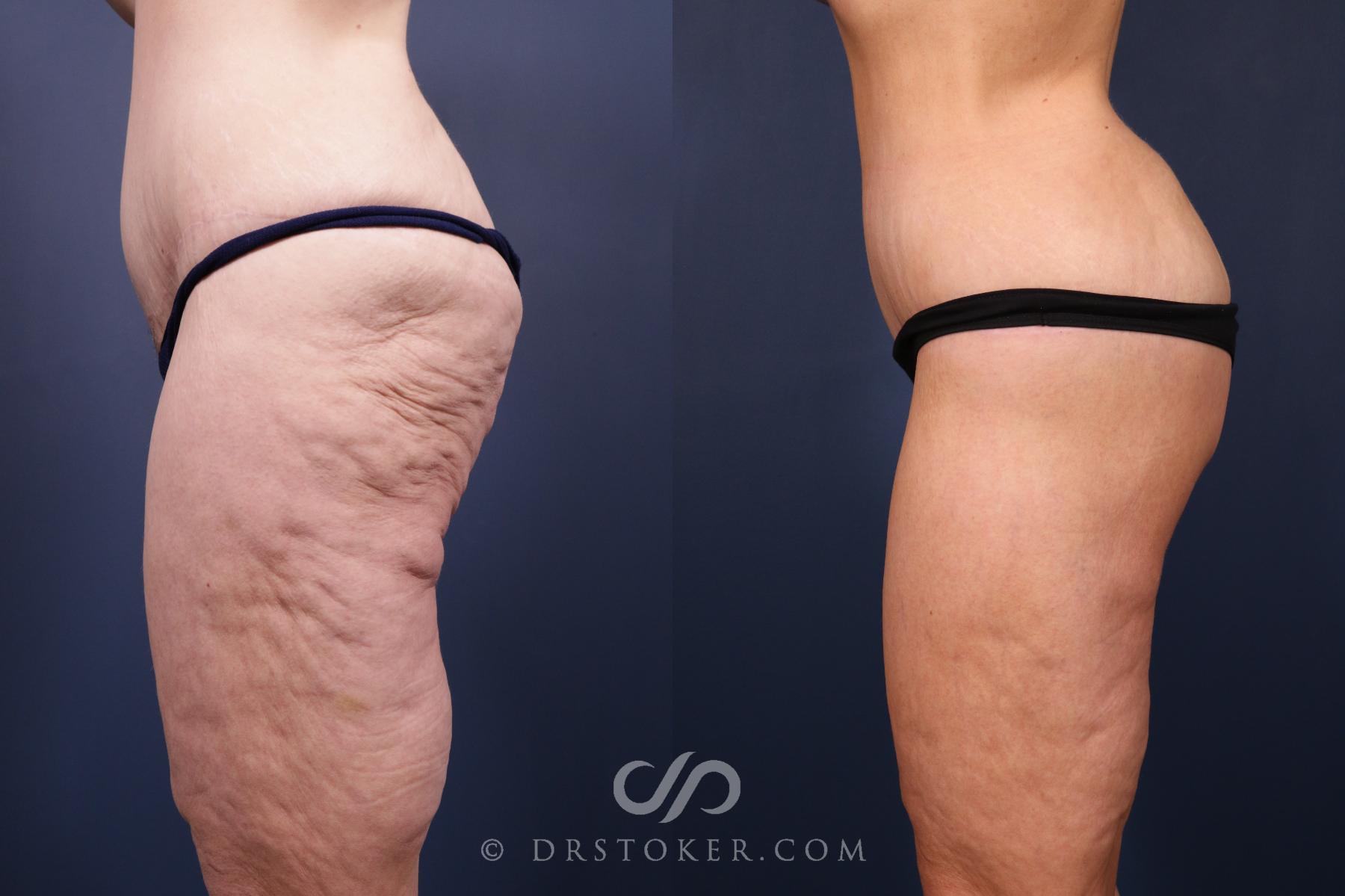 Before & After Bikini Body Lift ™ Case 2444 Left Side View in Los Angeles, CA