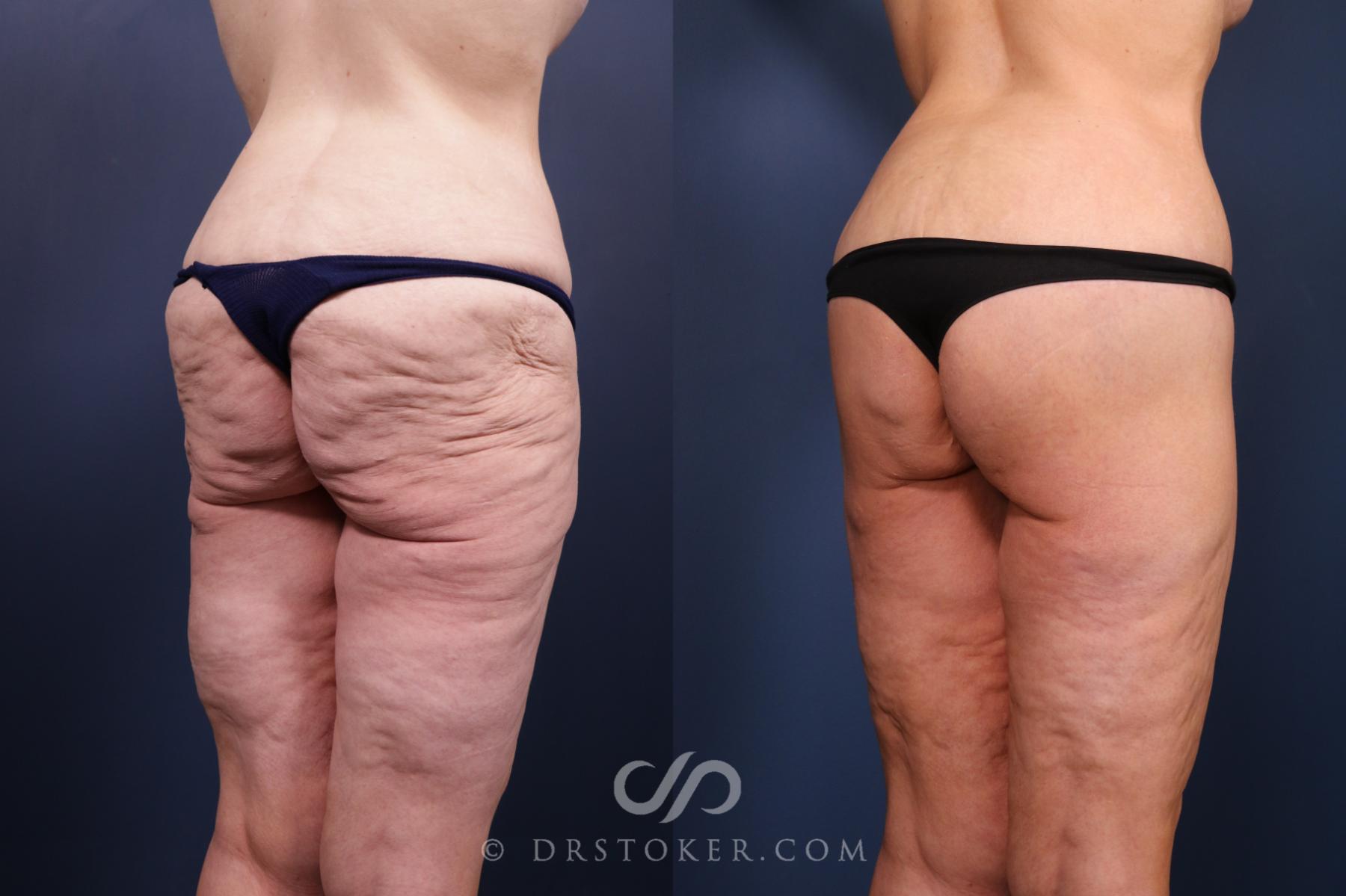 Before & After Bikini Body Lift ™ Case 2444 Right Oblique View in Los Angeles, CA