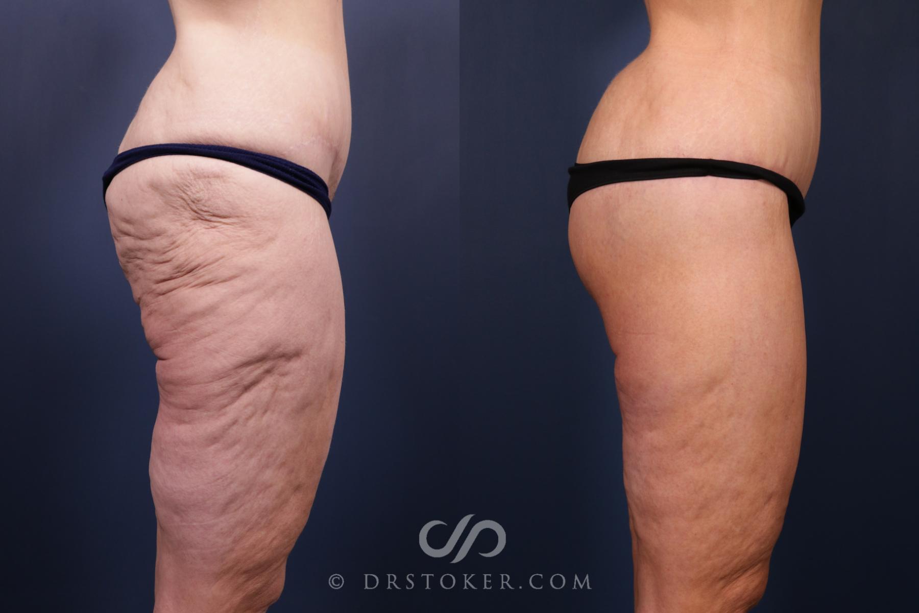 Before & After Bikini Body Lift ™ Case 2444 Right Side View in Los Angeles, CA