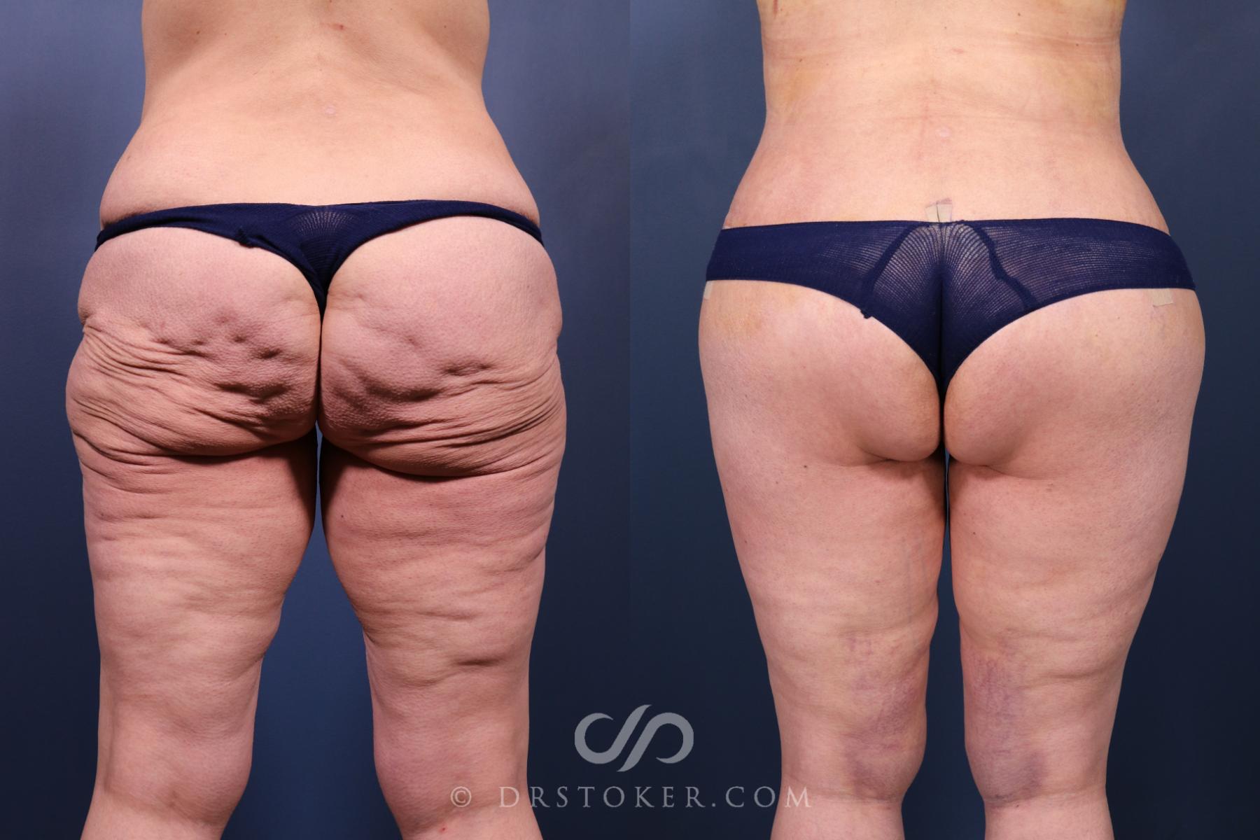 Before & After Bikini Body Lift ™ Case 2446 Back View in Los Angeles, CA
