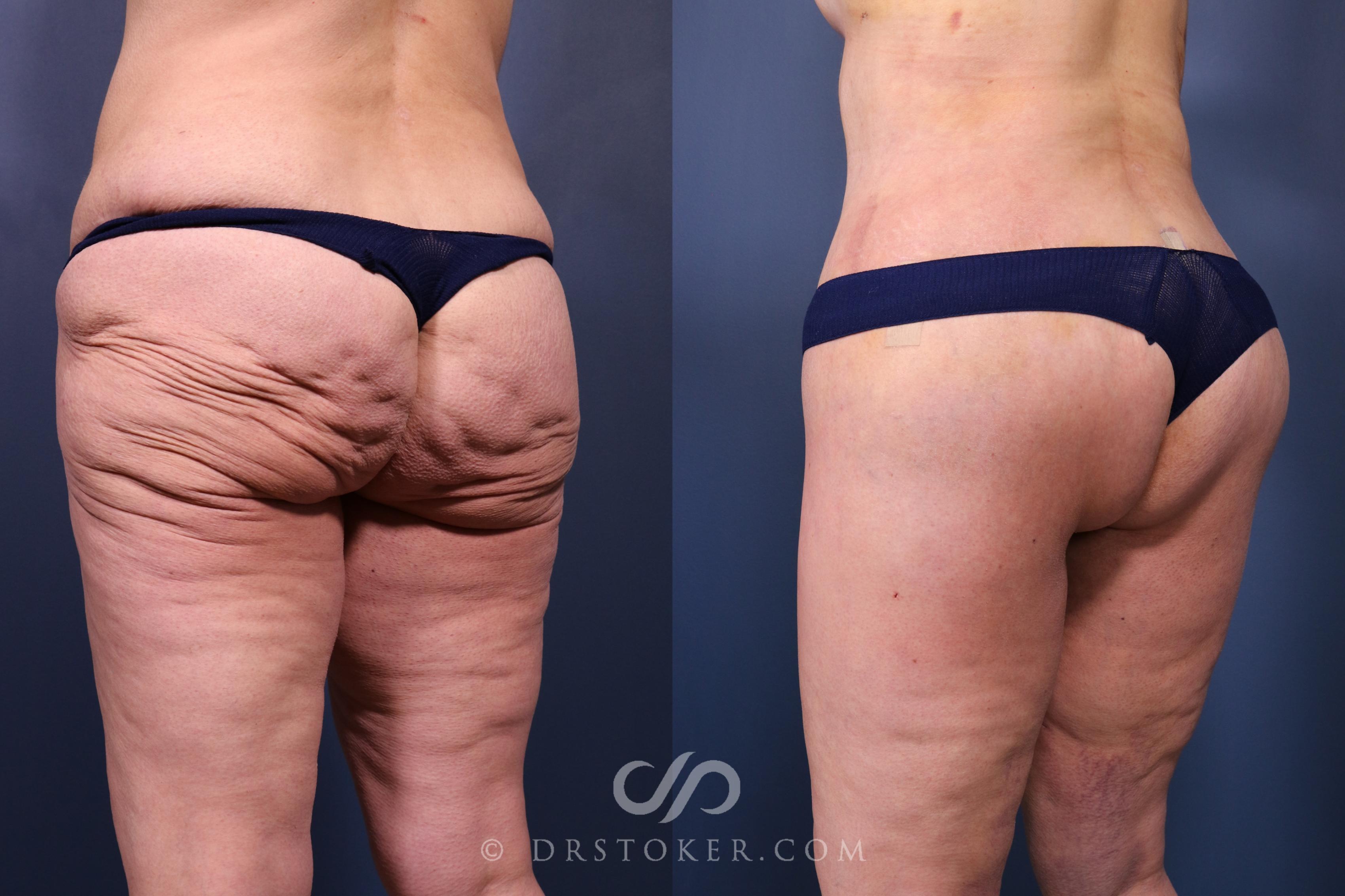 Before & After Bikini Body Lift ™ Case 2446 Left Oblique View in Los Angeles, CA