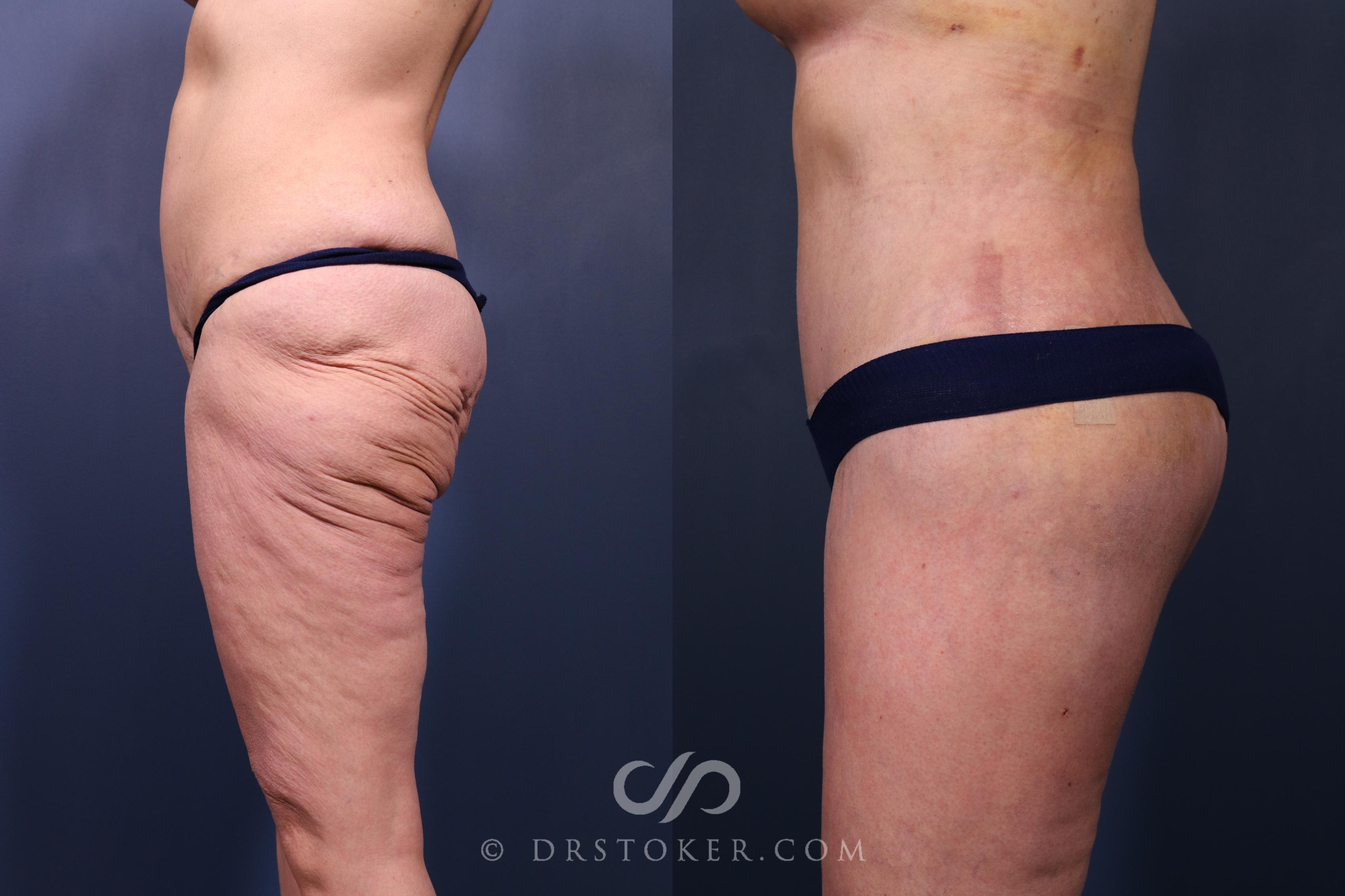 Before & After Bikini Body Lift ™ Case 2446 Left Side View in Los Angeles, CA