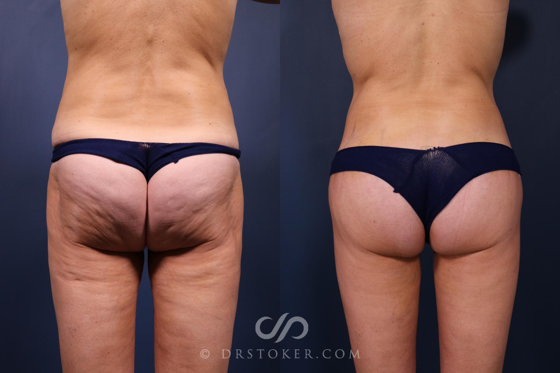 Before & After Bikini Body Lift ™ Case 2447 Back View in Los Angeles, CA