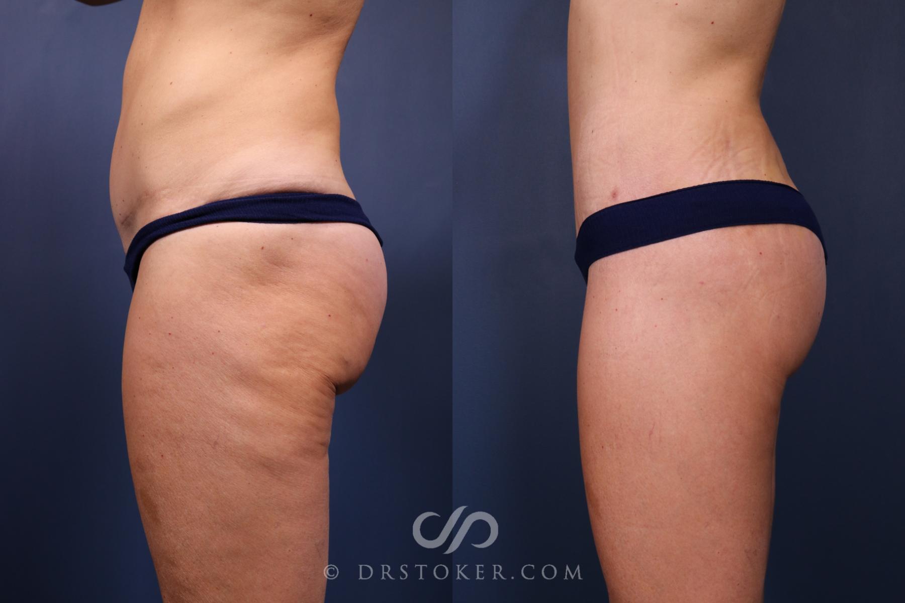 Before & After Bikini Body Lift ™ Case 2447 Left Side View in Los Angeles, CA