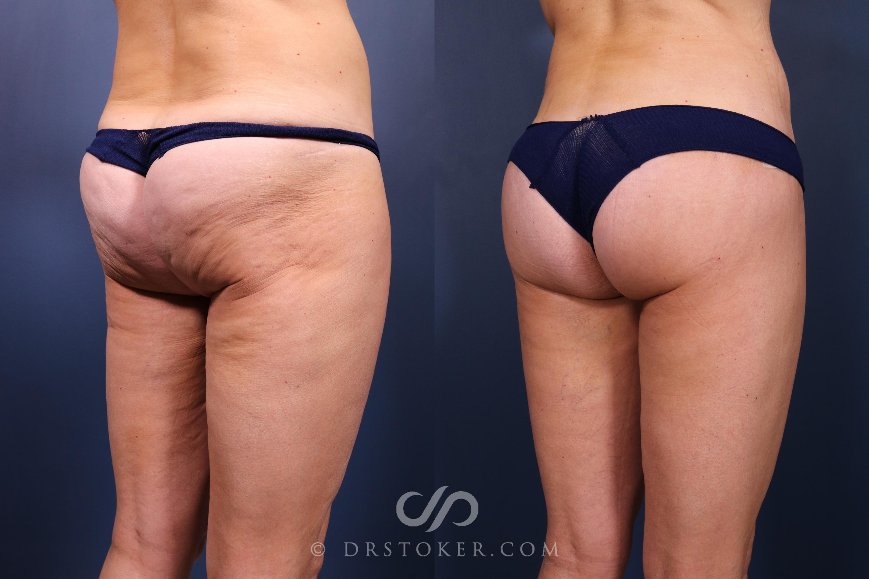Before & After Bikini Body Lift ™ Case 2447 Right Oblique View in Los Angeles, CA