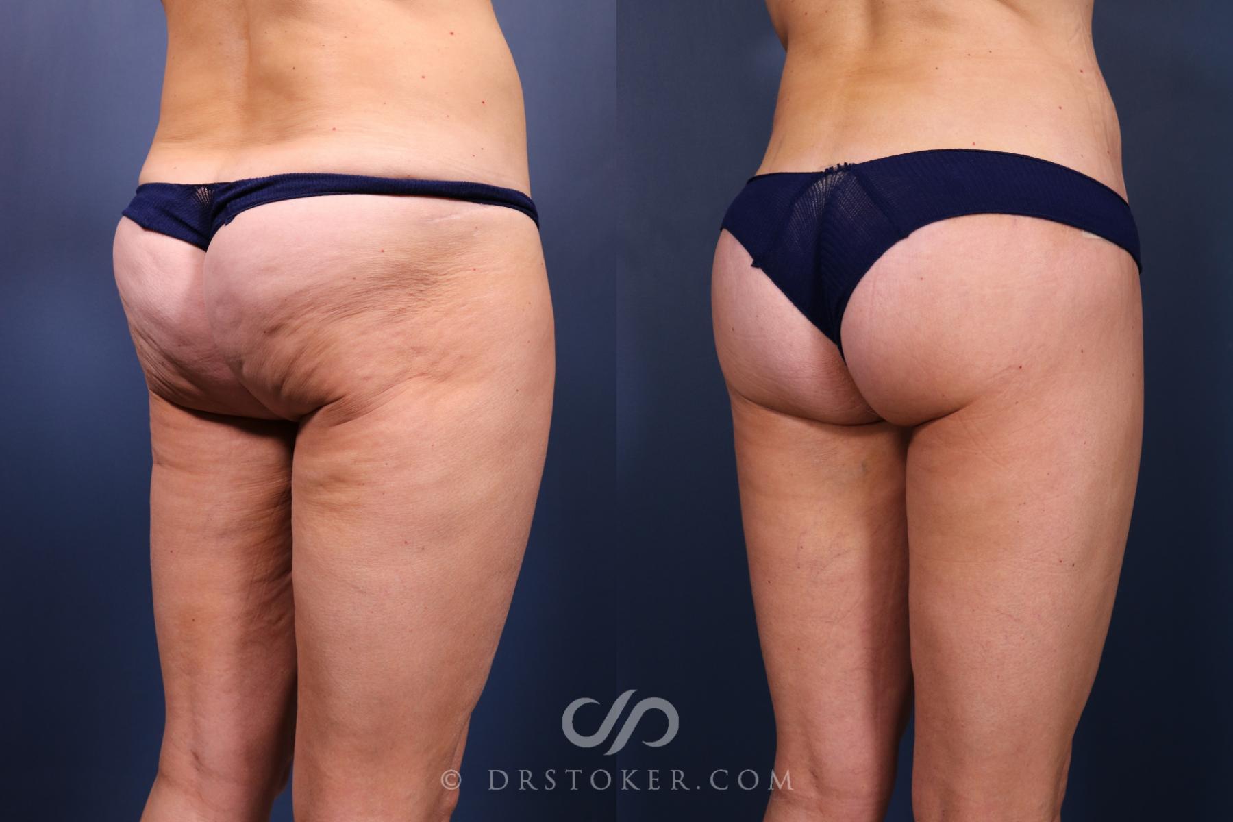 Before & After Bikini Body Lift ™ Case 2447 Right Oblique View in Los Angeles, CA