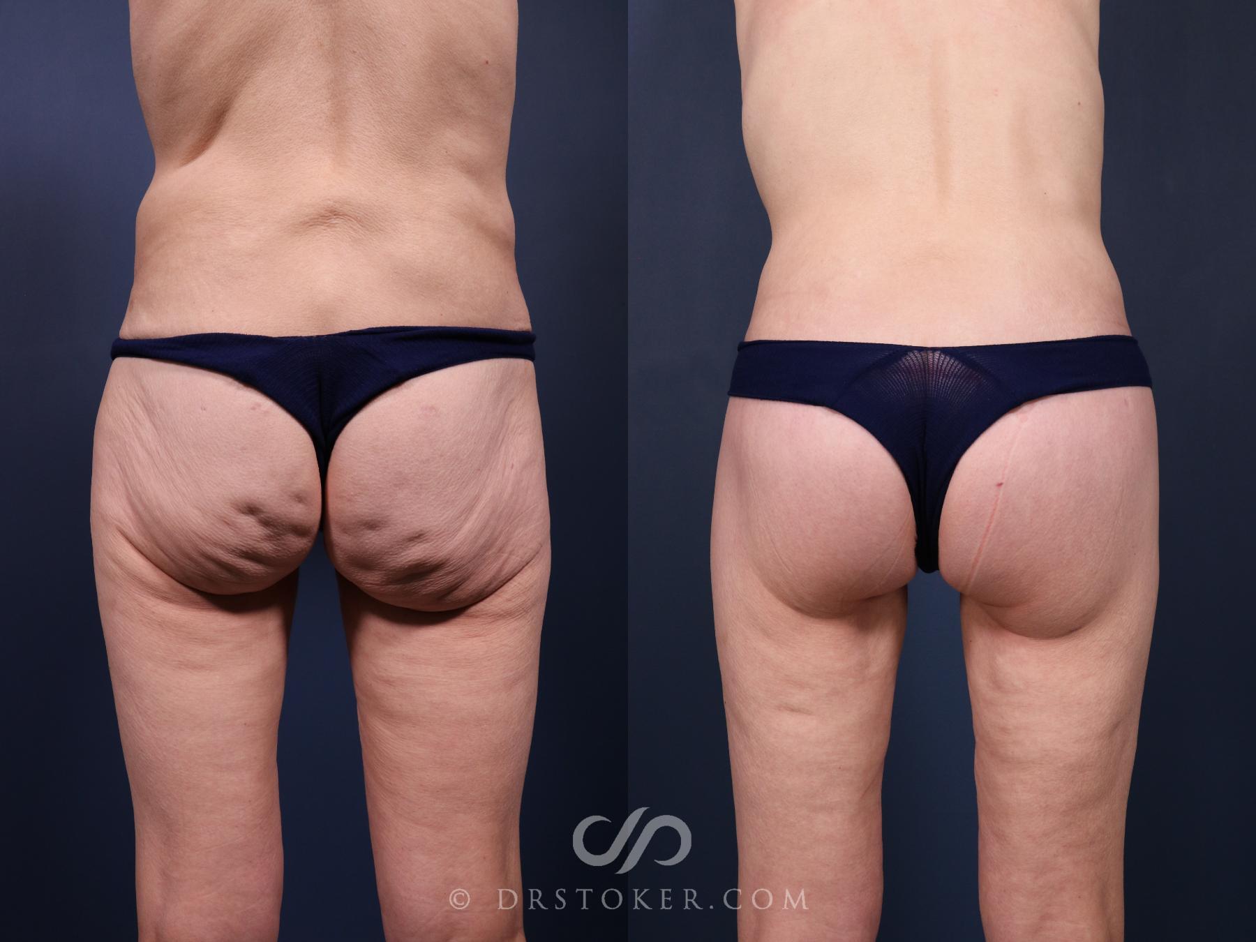 Before & After Bikini Body Lift ™ Case 2448 Back View in Los Angeles, CA