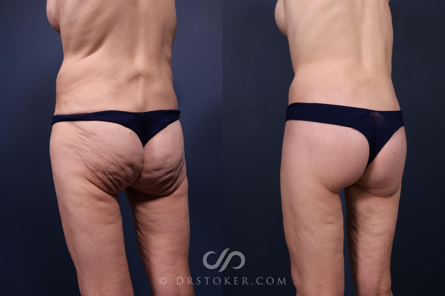 Before & After Bikini Body Lift ™ Case 2448 Left Oblique View in Los Angeles, CA