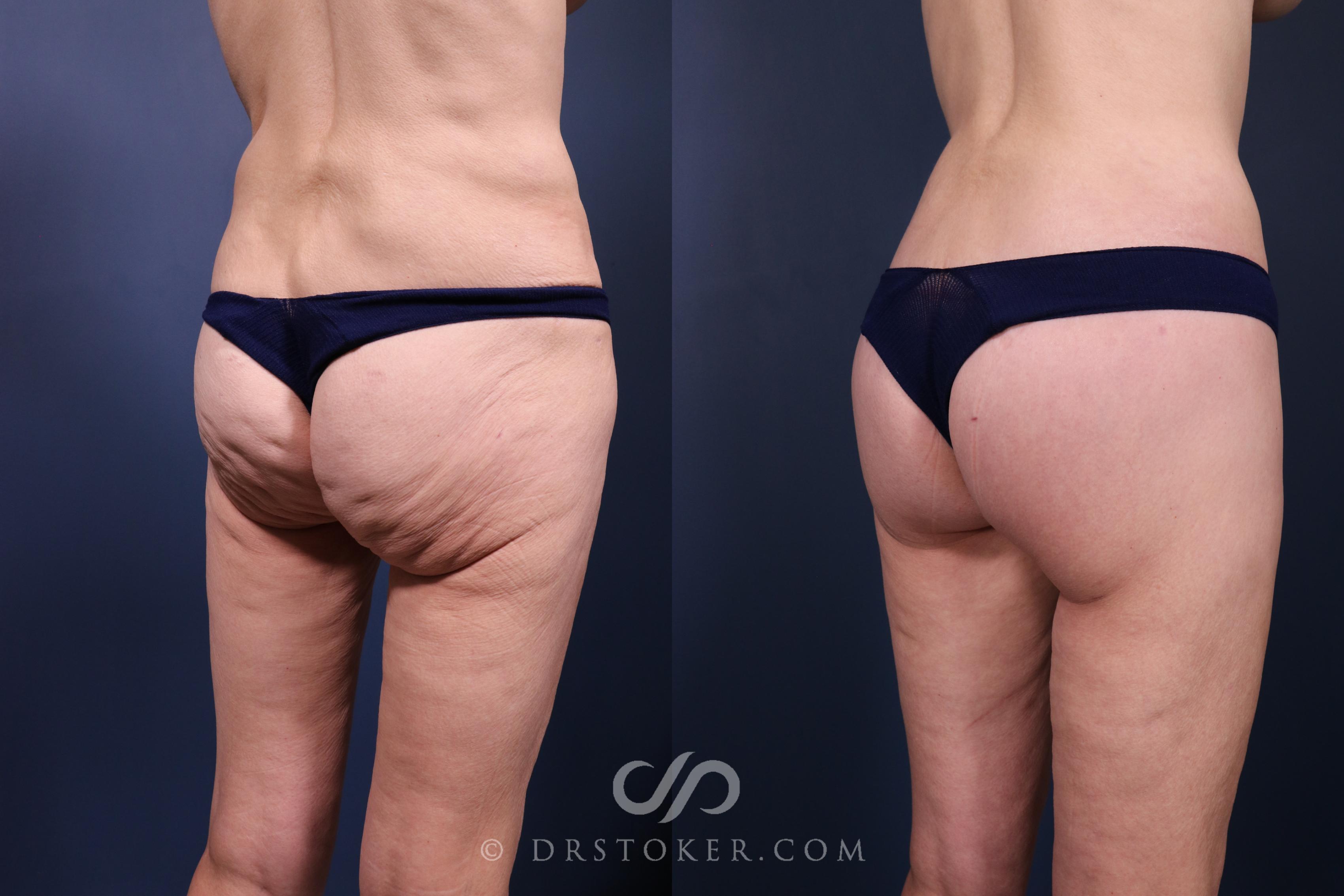 Before & After Bikini Body Lift ™ Case 2448 Right Oblique View in Los Angeles, CA