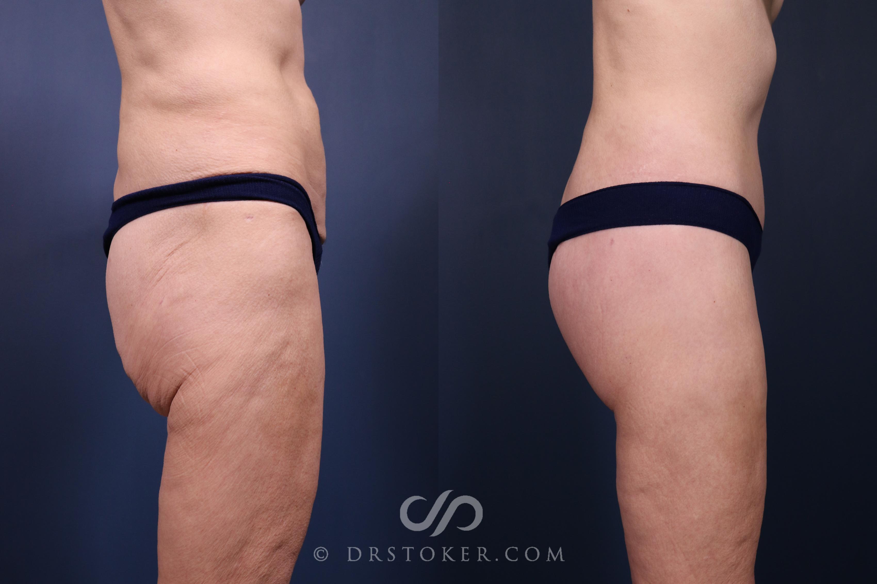 Before & After Bikini Body Lift ™ Case 2448 Right Side View in Los Angeles, CA