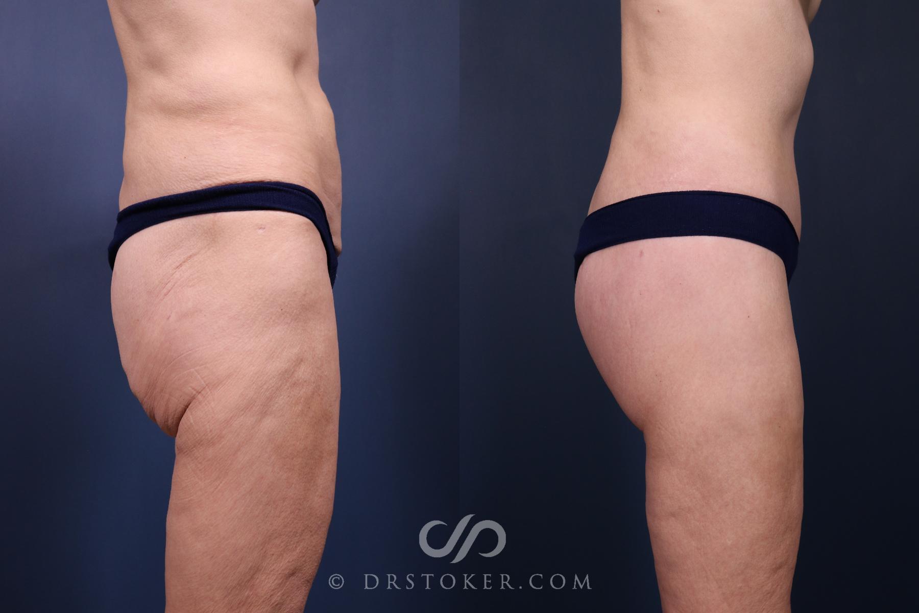 Before & After Bikini Body Lift ™ Case 2448 Right Side View in Los Angeles, CA