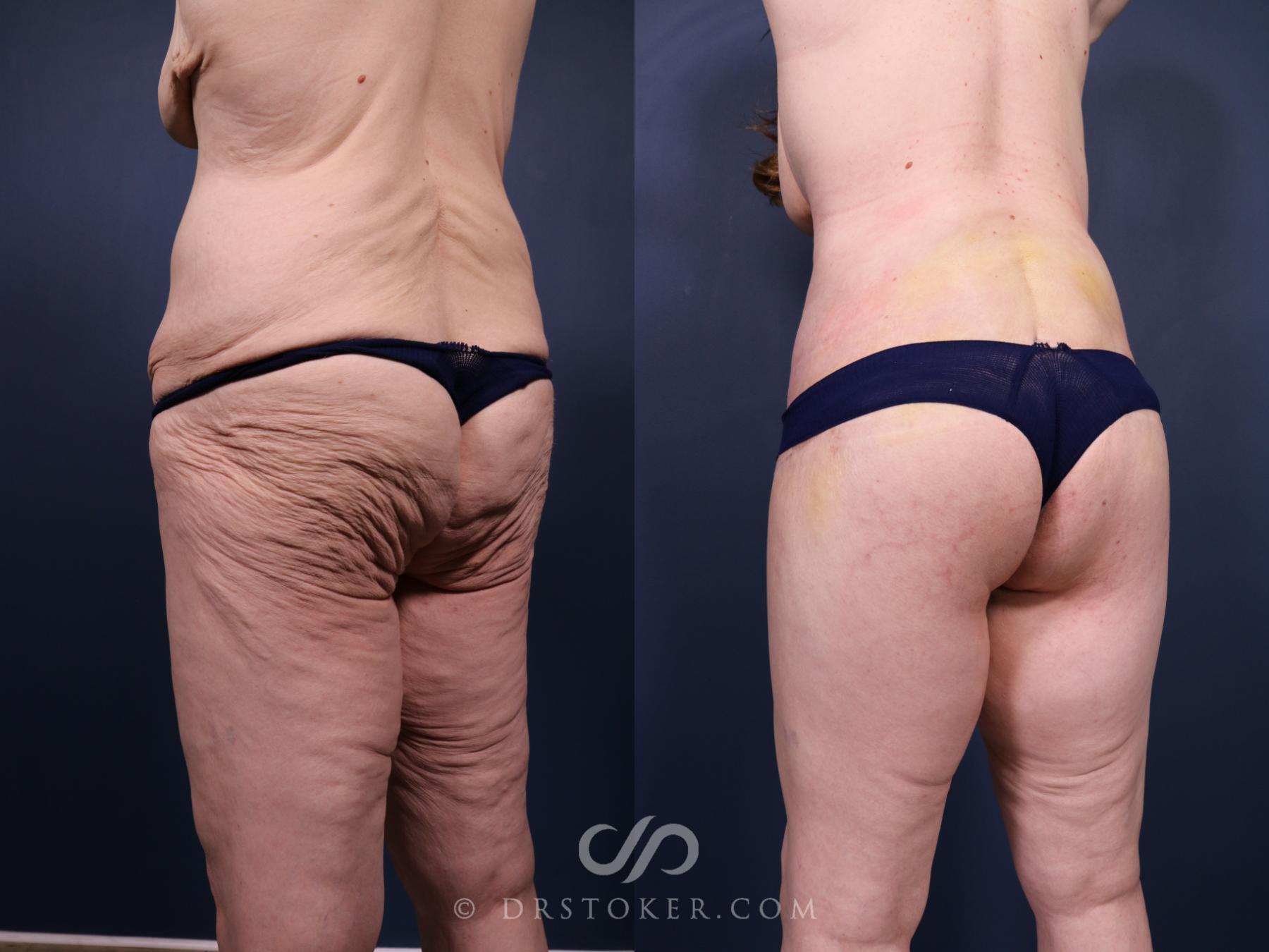 Before & After Bikini Body Lift ™ Case 2449 Left Oblique View in Los Angeles, CA