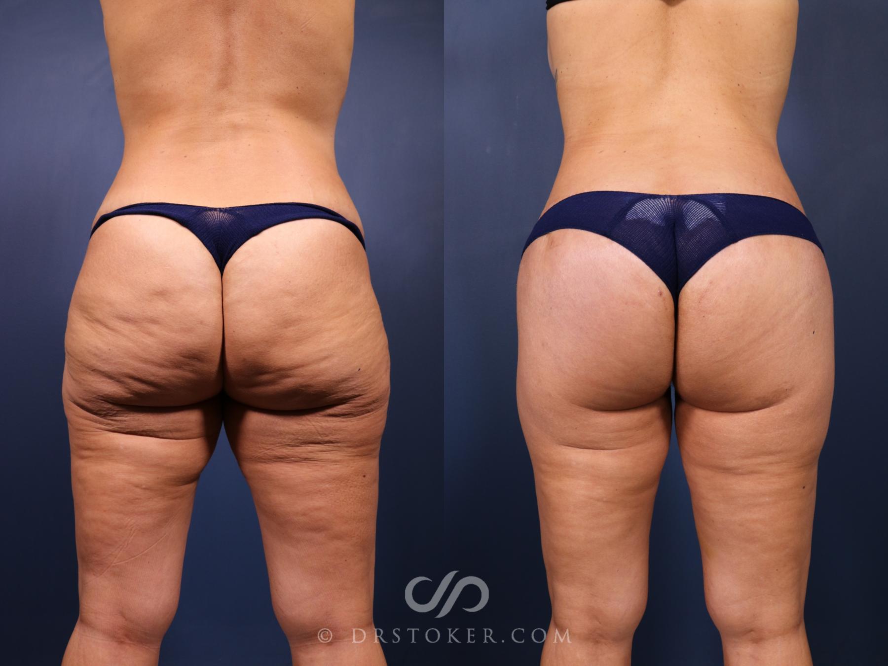 Before & After Bikini Body Lift ™ Case 2450 Back View in Los Angeles, CA