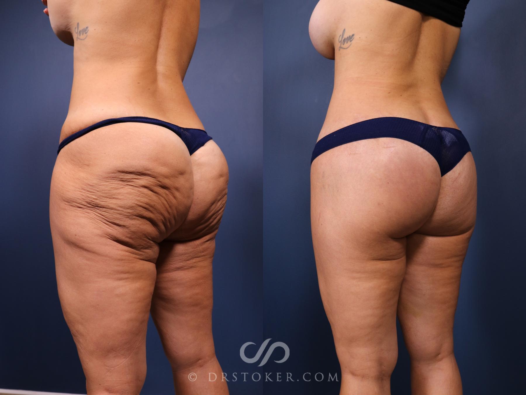 Before & After Bikini Body Lift ™ Case 2450 Left Oblique View in Los Angeles, CA
