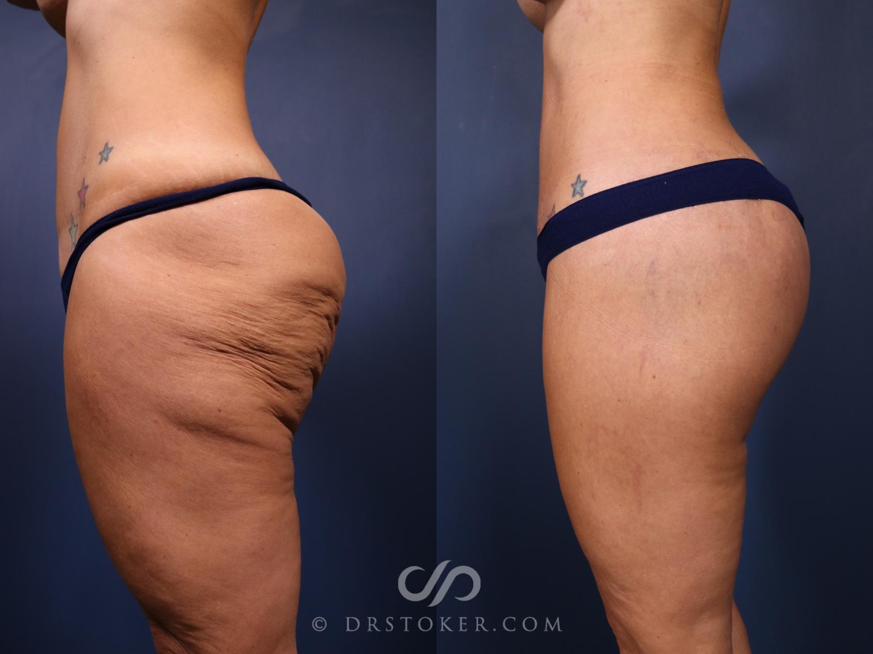 Before & After Bikini Body Lift ™ Case 2450 Left Side View in Los Angeles, CA