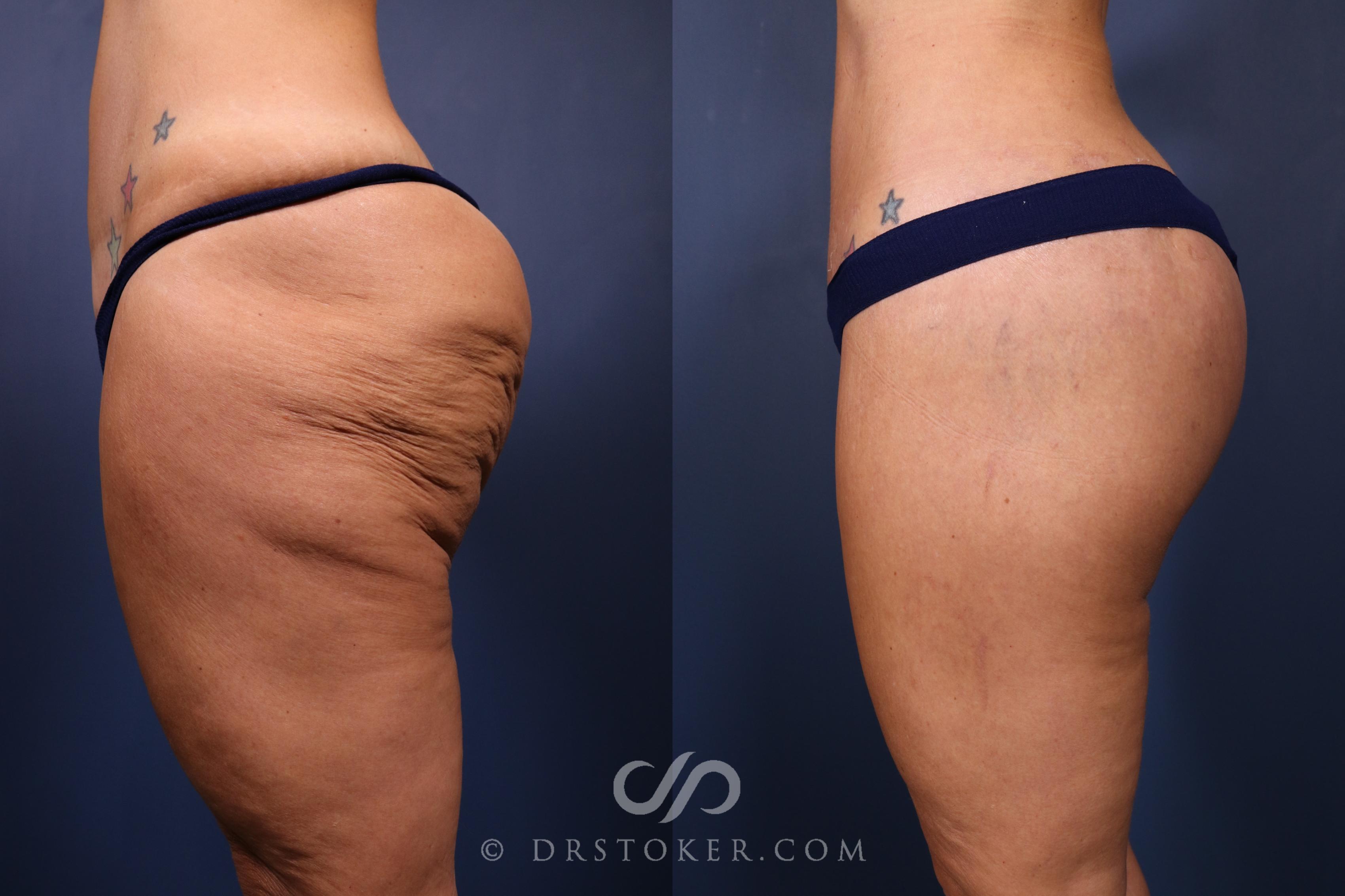 Before & After Bikini Body Lift ™ Case 2451 Left Side View in Los Angeles, CA