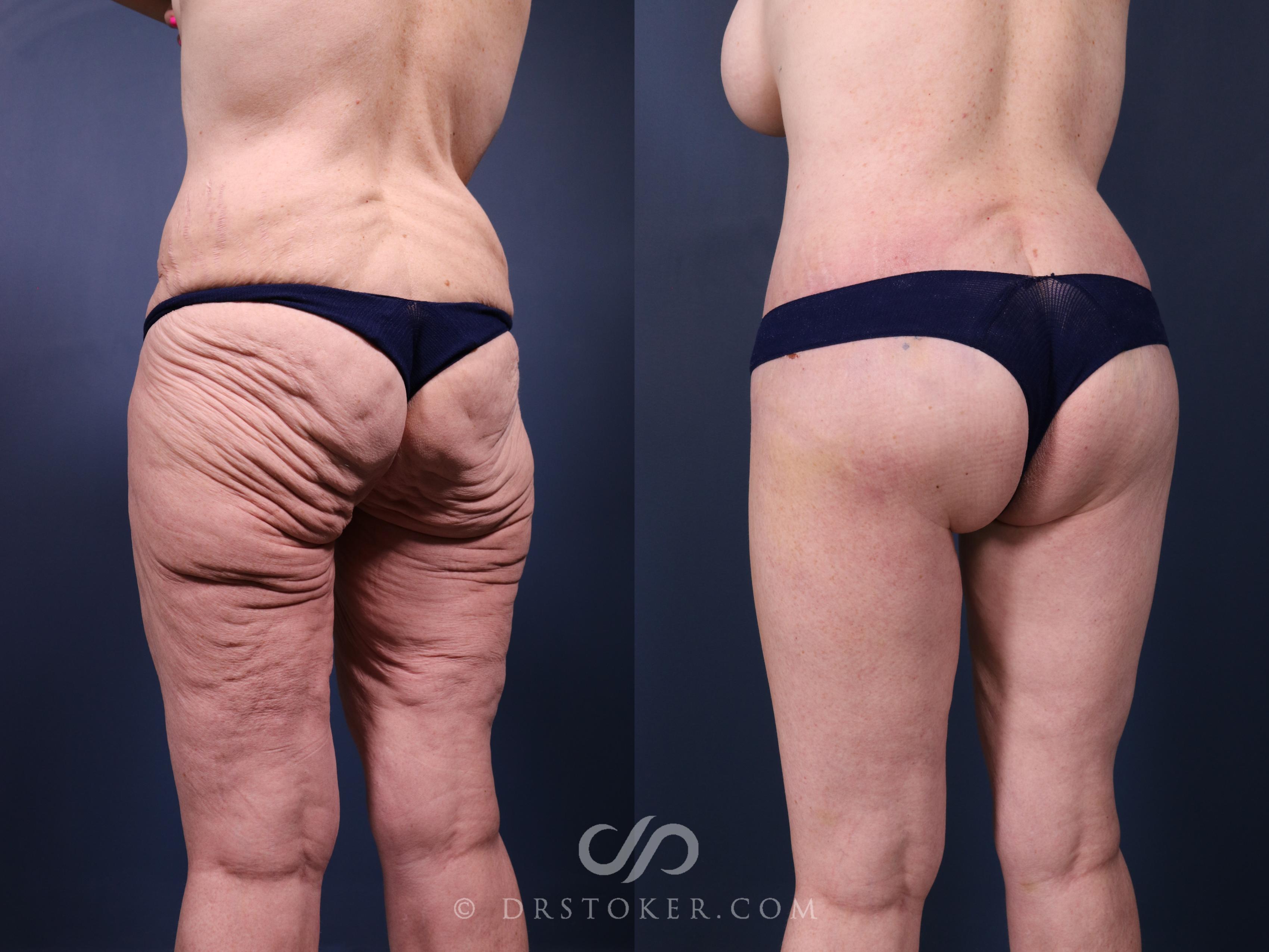 Before & After Bikini Body Lift ™ Case 2452 Back View in Los Angeles, CA
