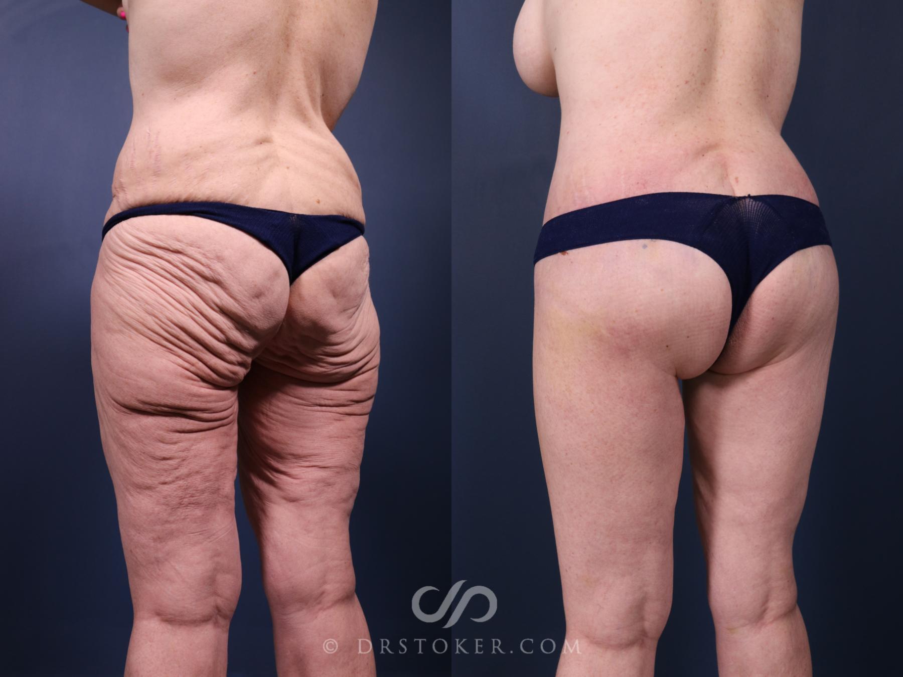 Before & After Bikini Body Lift ™ Case 2452 Back View in Los Angeles, CA