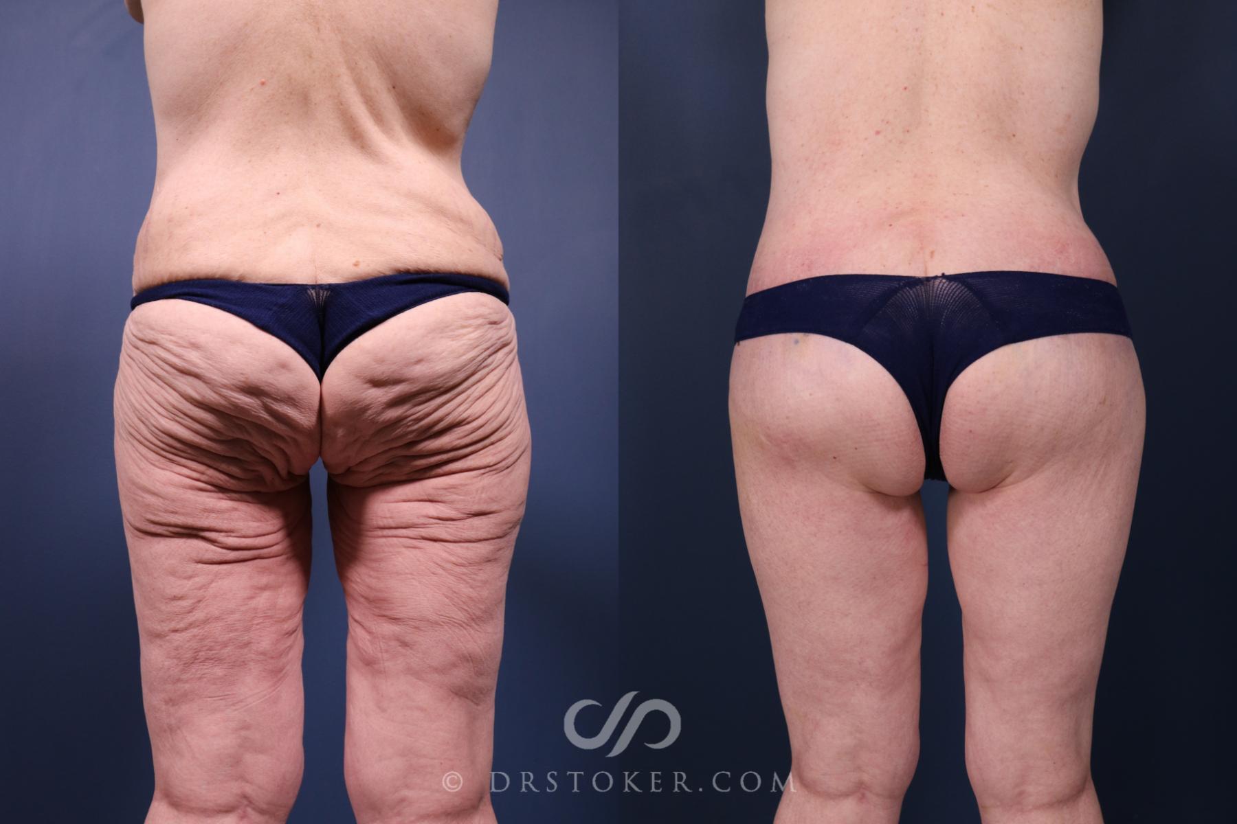 Before & After Bikini Body Lift ™ Case 2452 Posterior View in Los Angeles, CA