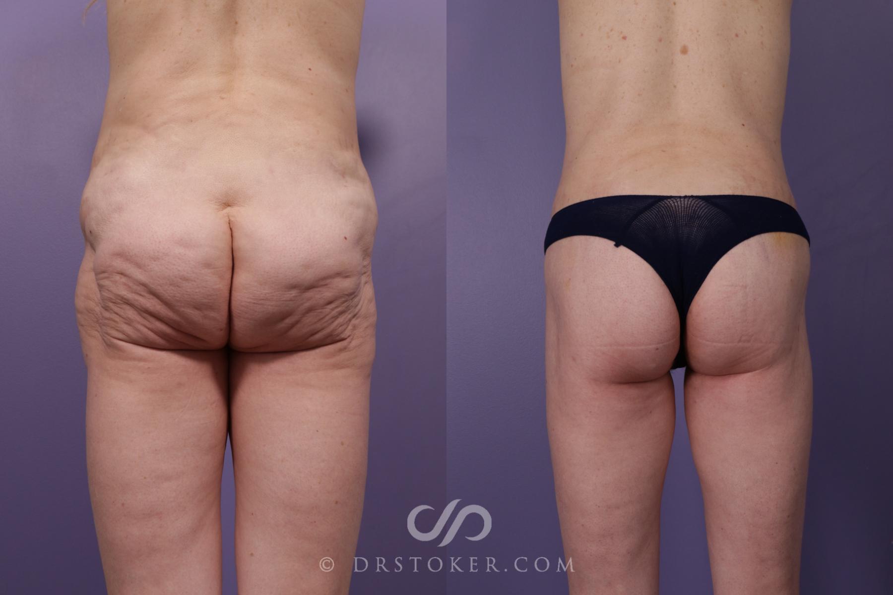 Before & After Bikini Body Lift ™ Case 2453 Back View in Los Angeles, CA