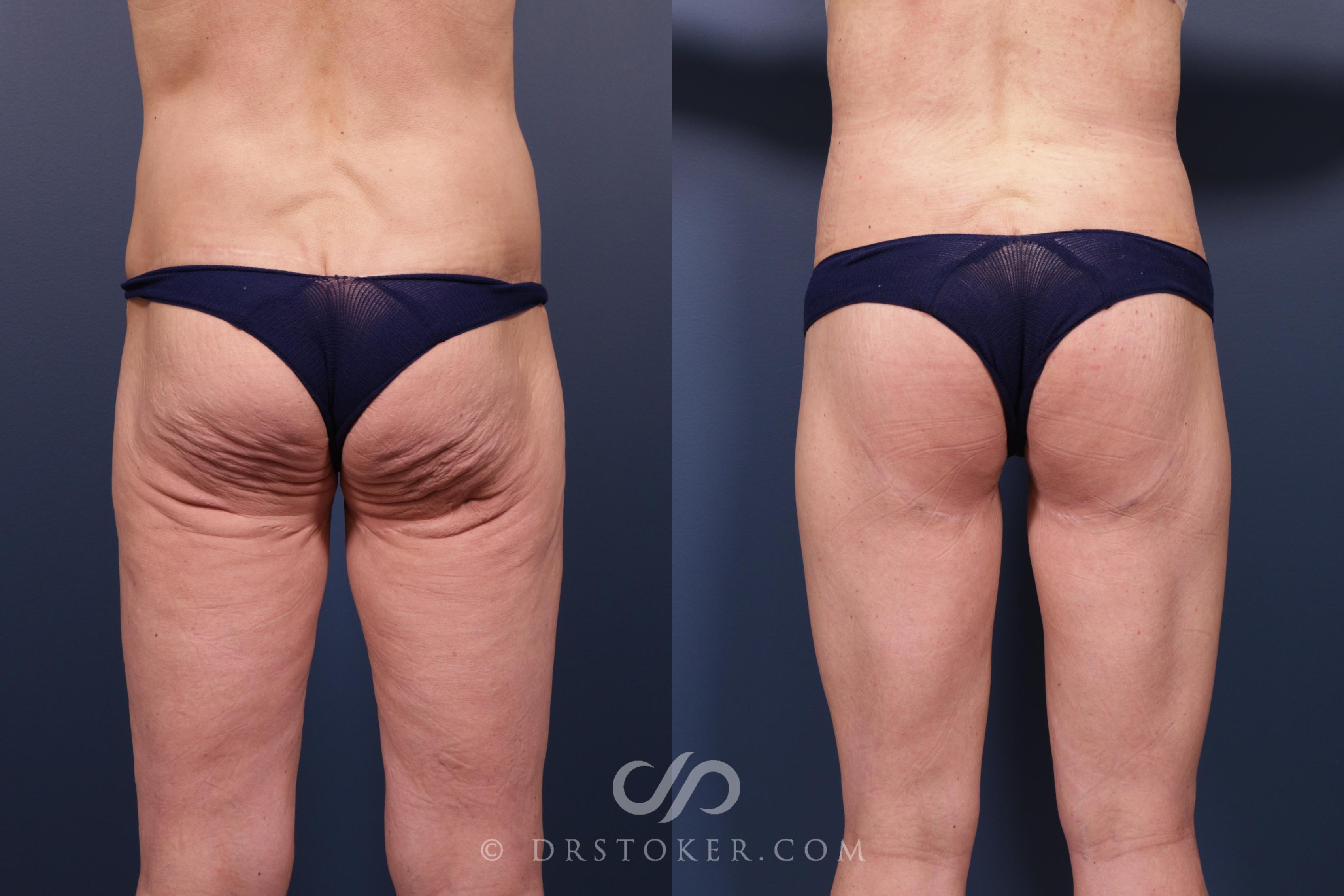 Before & After Bikini Body Lift ™ Case 2454 Back View in Los Angeles, CA