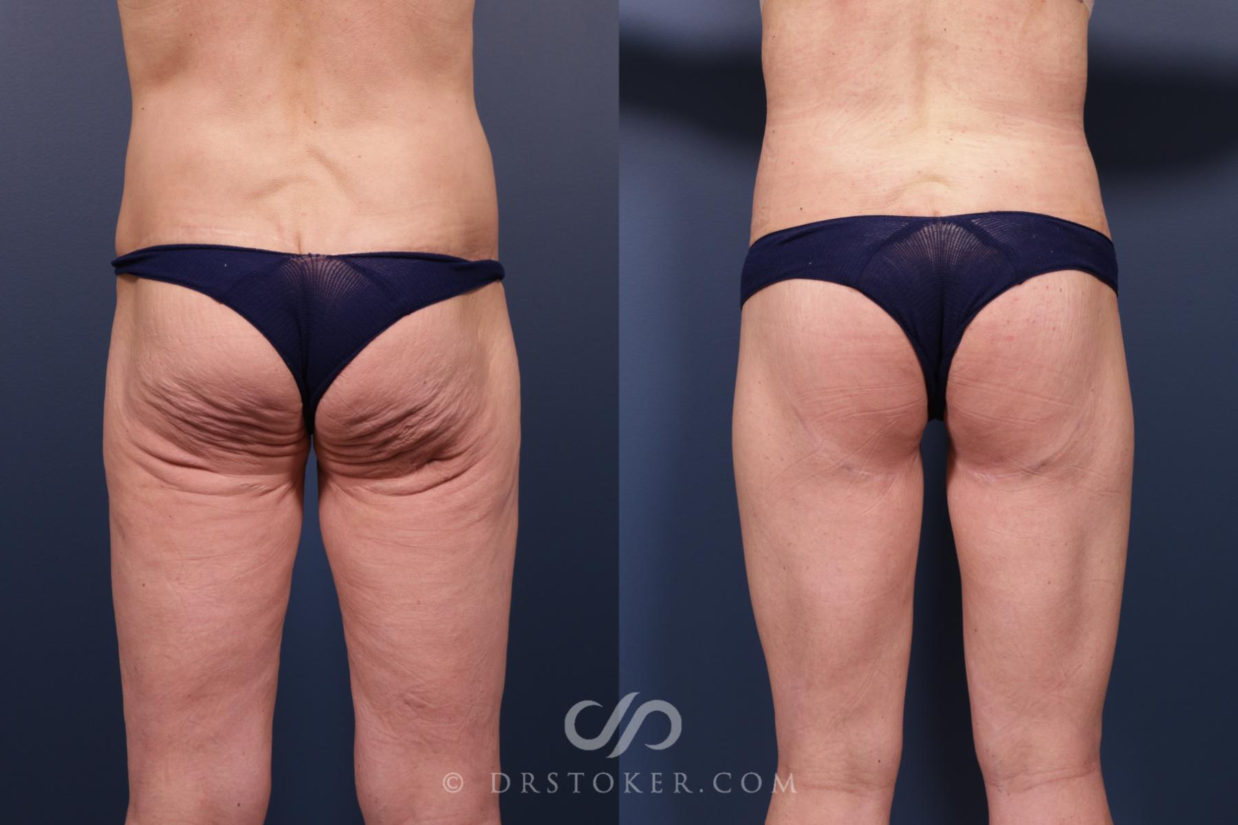 Before & After Bikini Body Lift ™ Case 2454 Back View in Los Angeles, CA