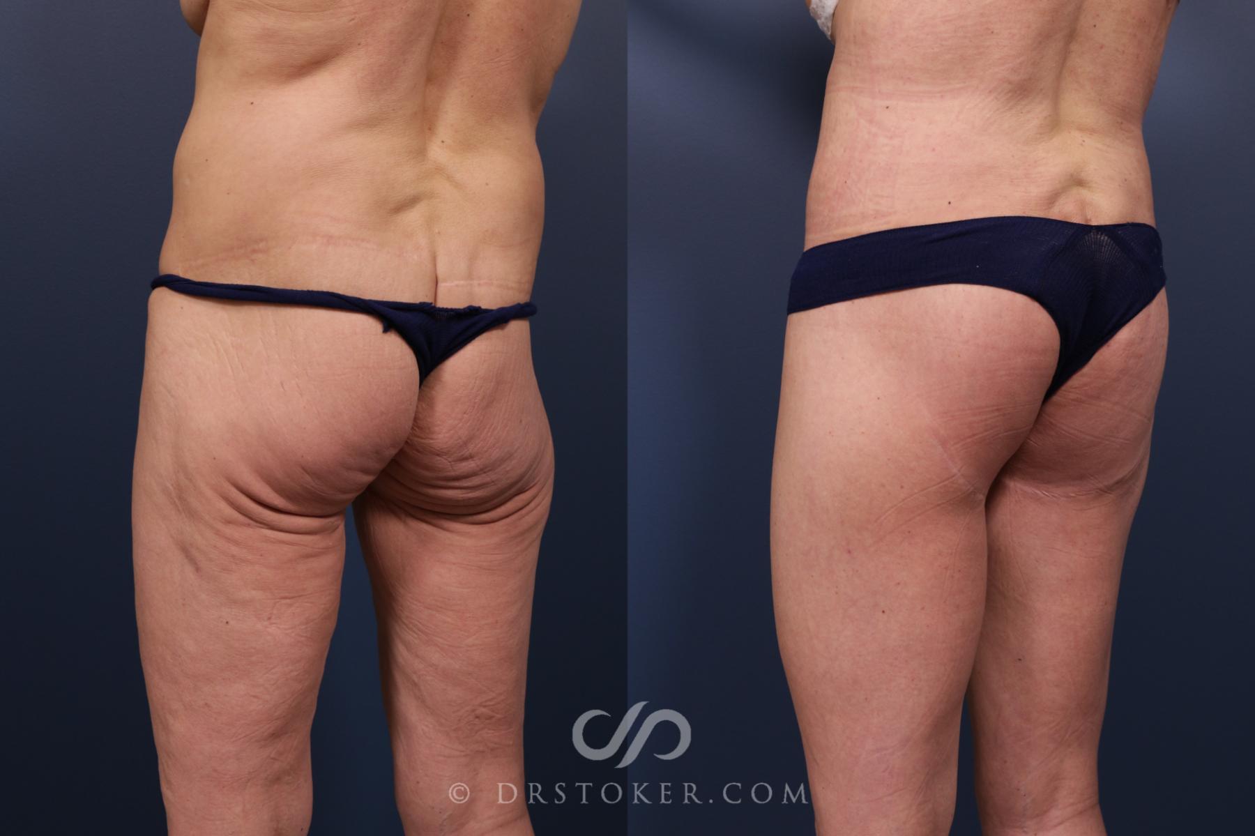 Before & After Bikini Body Lift ™ Case 2454 Left Oblique View in Los Angeles, CA