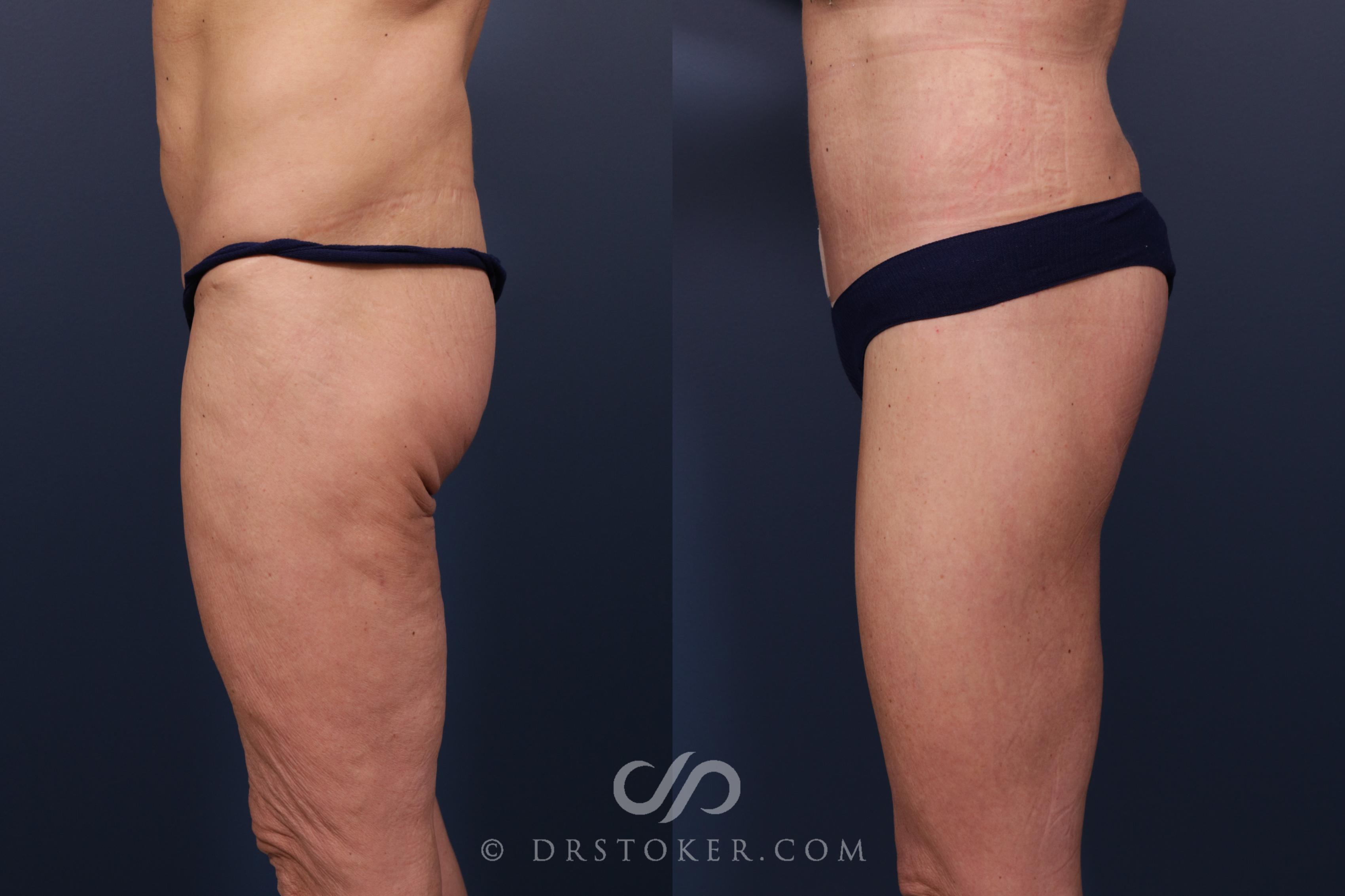 Before & After Bikini Body Lift ™ Case 2454 Left Side View in Los Angeles, CA