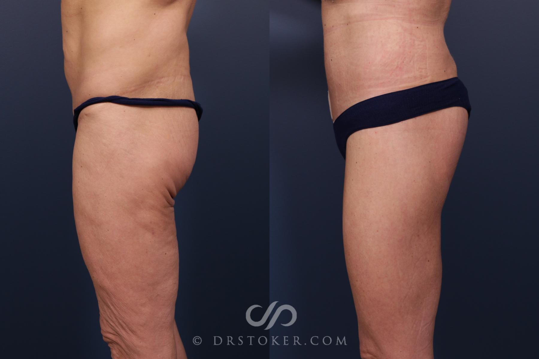 Before & After Bikini Body Lift ™ Case 2454 Left Side View in Los Angeles, CA