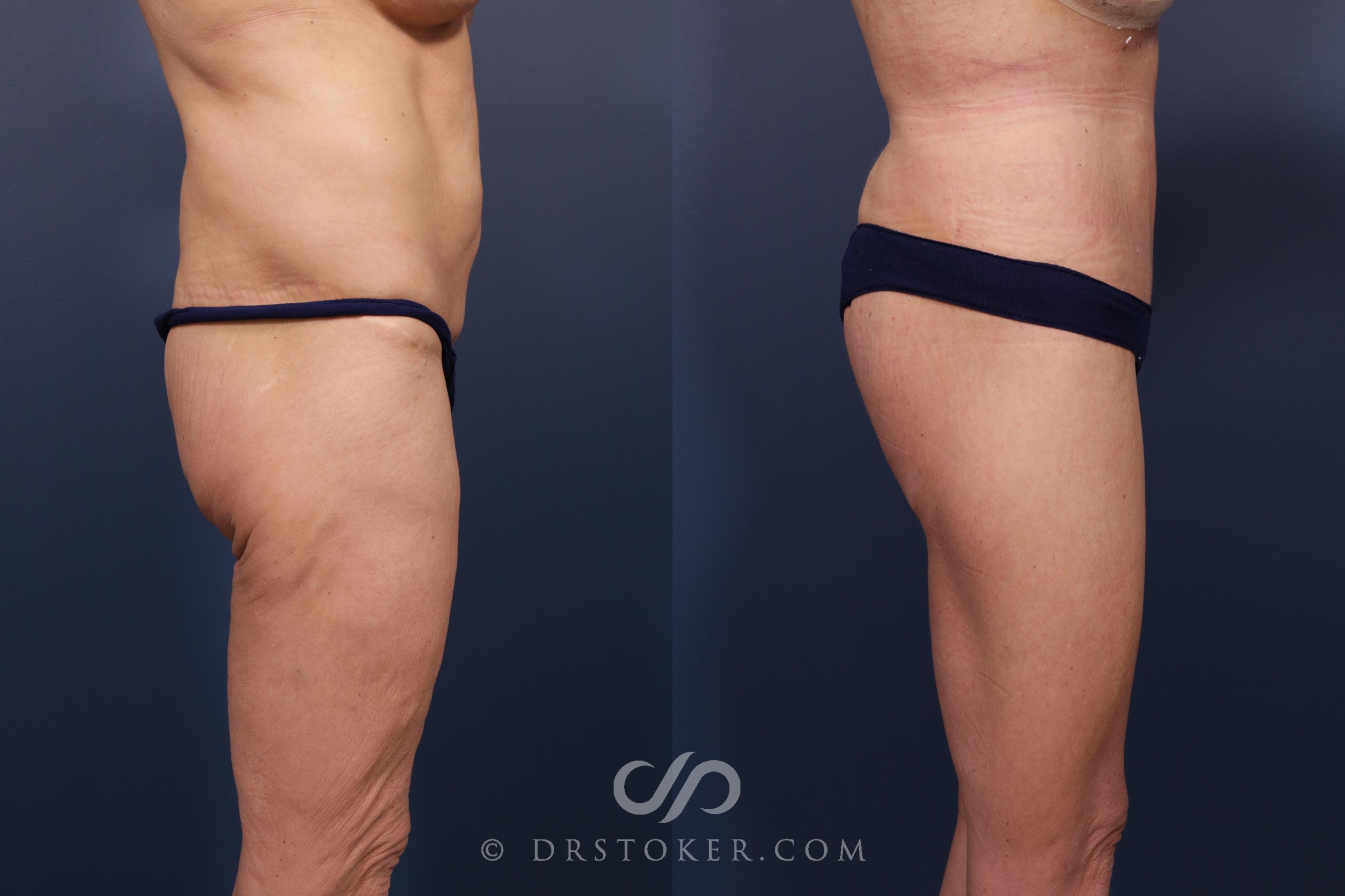 Before & After Bikini Body Lift ™ Case 2454 Right Side View in Los Angeles, CA