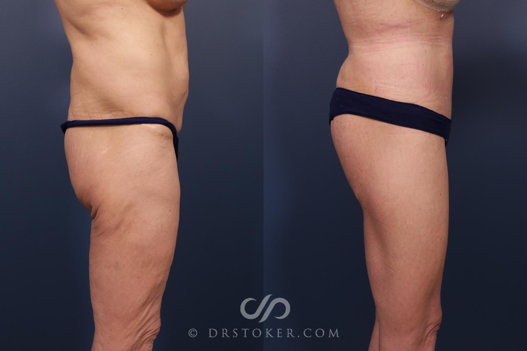 Before & After Bikini Body Lift ™ Case 2454 Right Side View in Los Angeles, CA