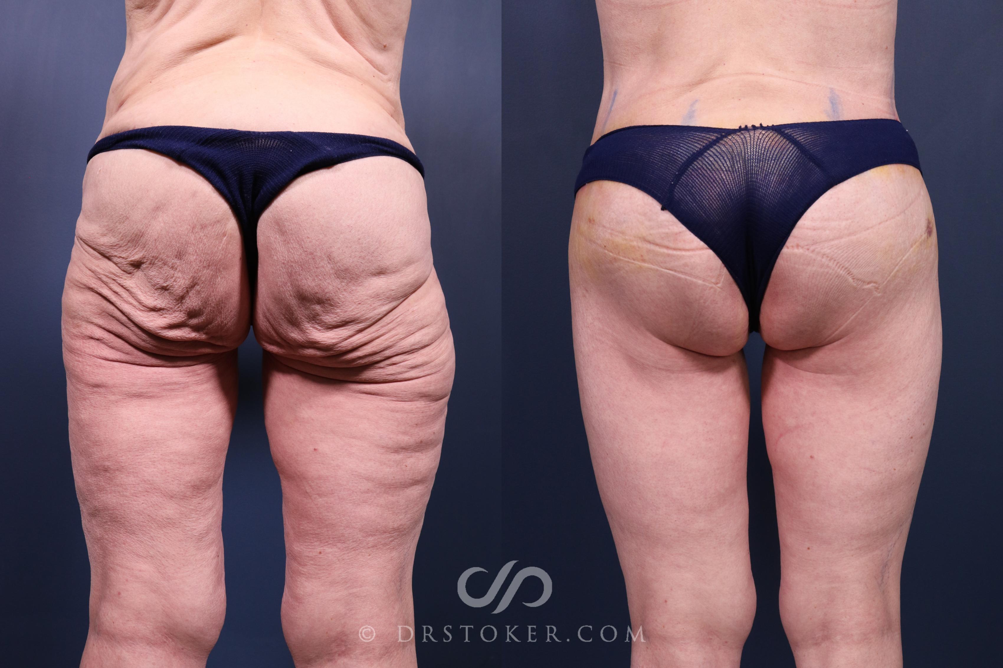 Before & After Bikini Body Lift ™ Case 2455 Back View in Los Angeles, CA