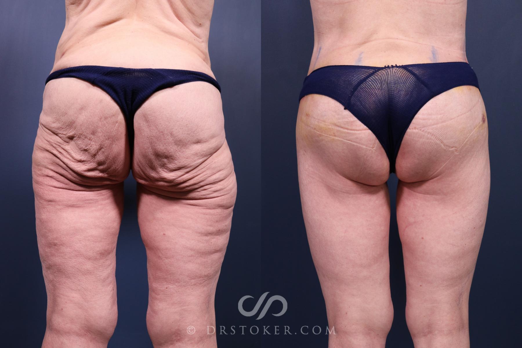 Before & After Bikini Body Lift ™ Case 2455 Back View in Los Angeles, CA