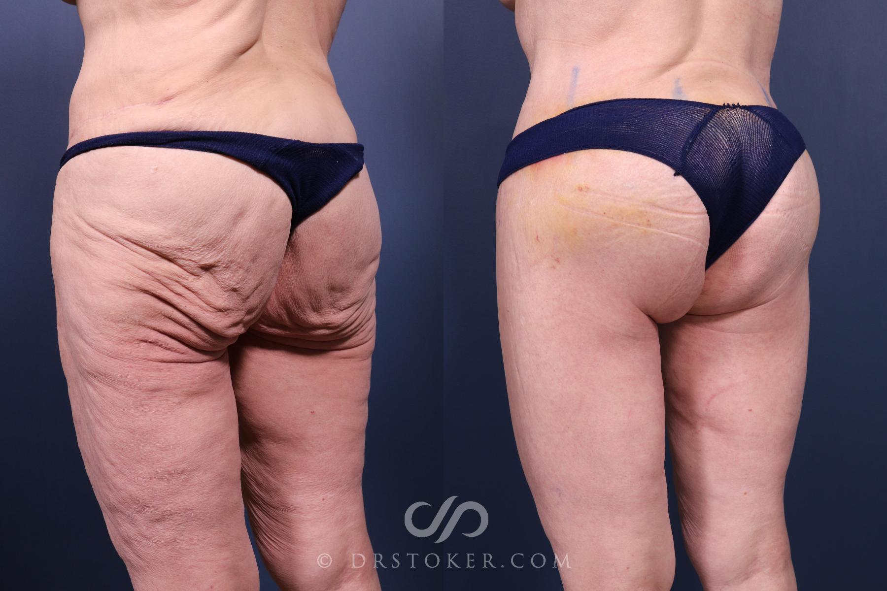 Before & After Bikini Body Lift ™ Case 2455 Left Oblique View in Los Angeles, CA