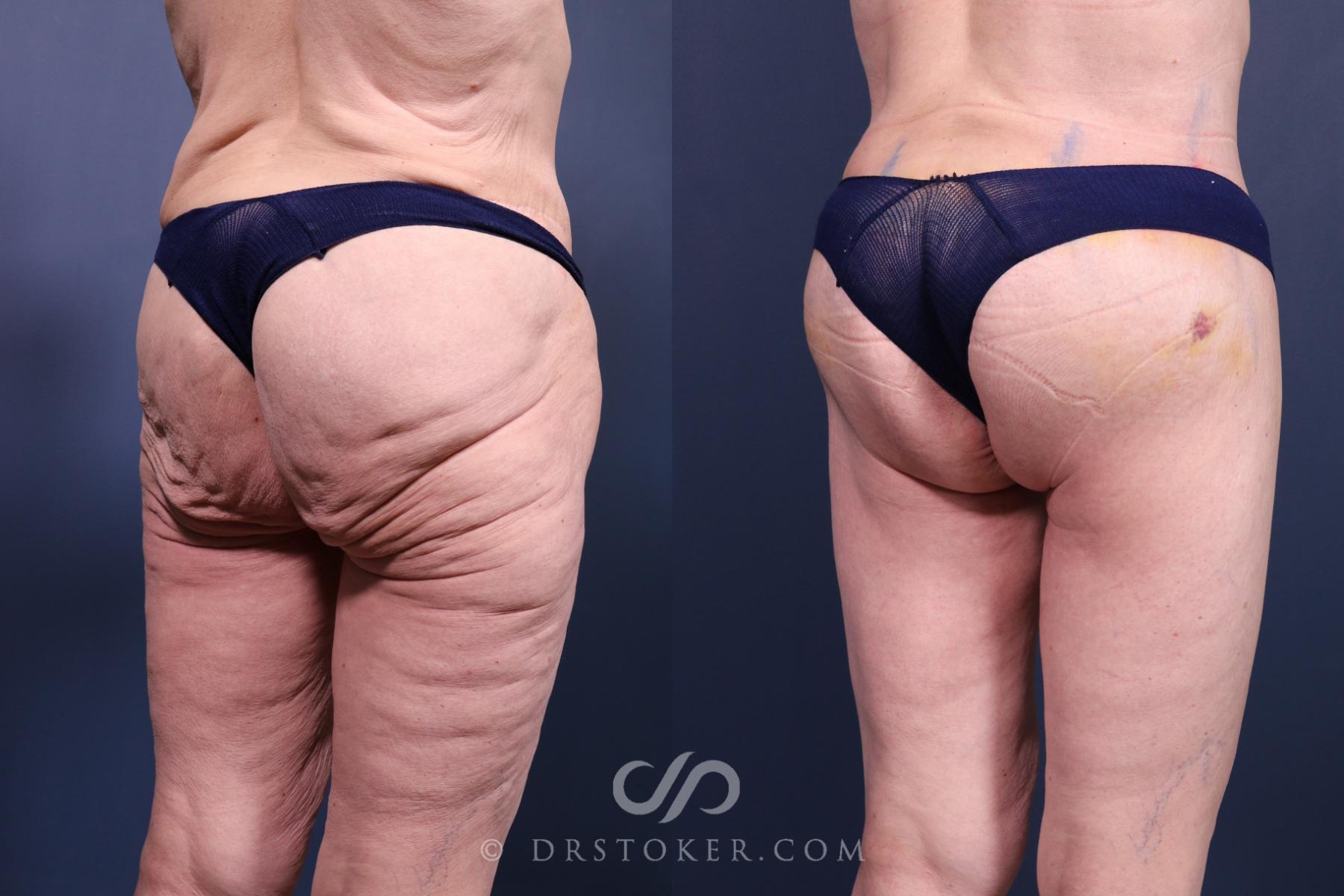 Before & After Bikini Body Lift ™ Case 2455 Right Oblique View in Los Angeles, CA