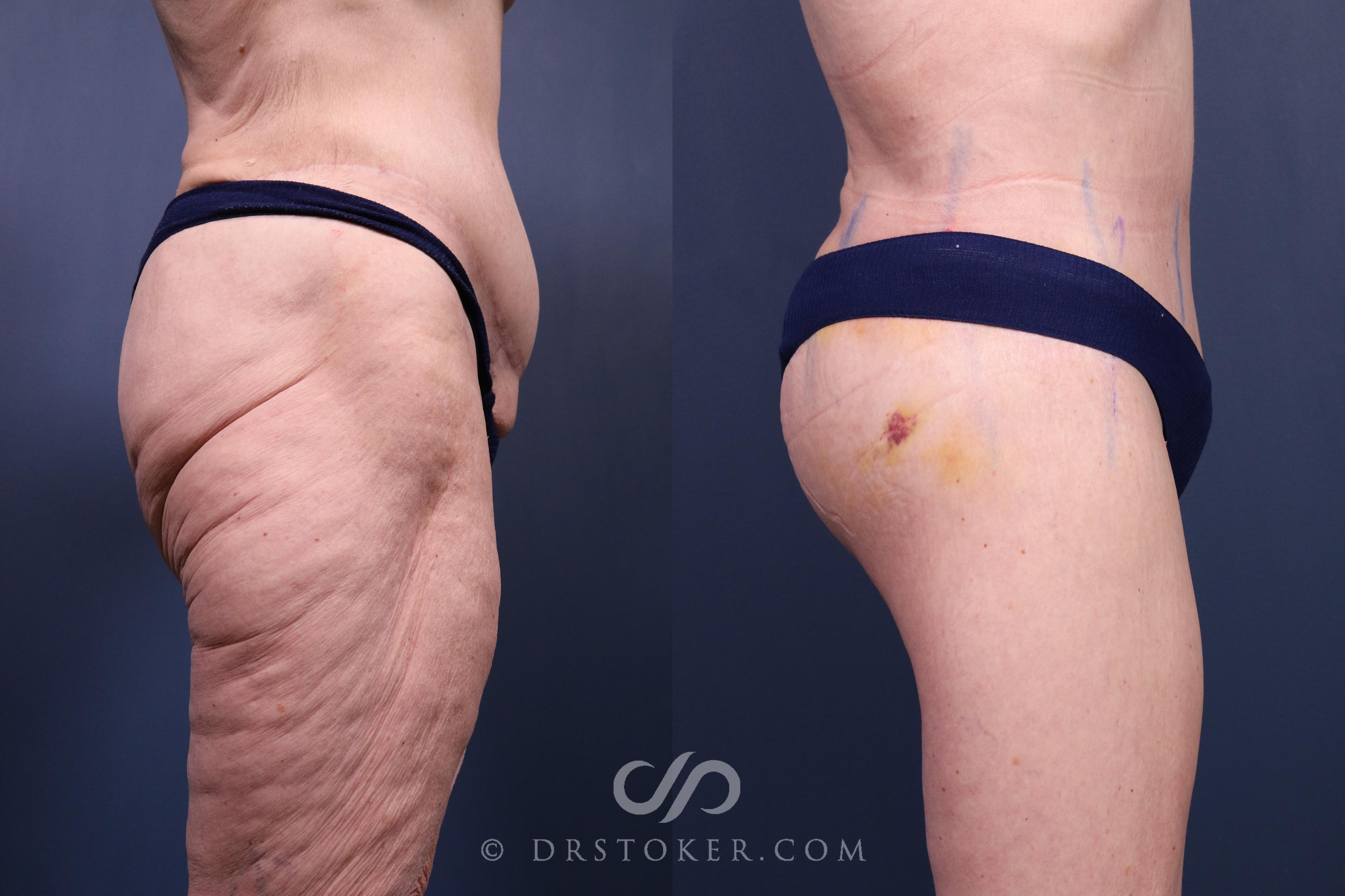 Before & After Bikini Body Lift ™ Case 2455 Right Side View in Los Angeles, CA